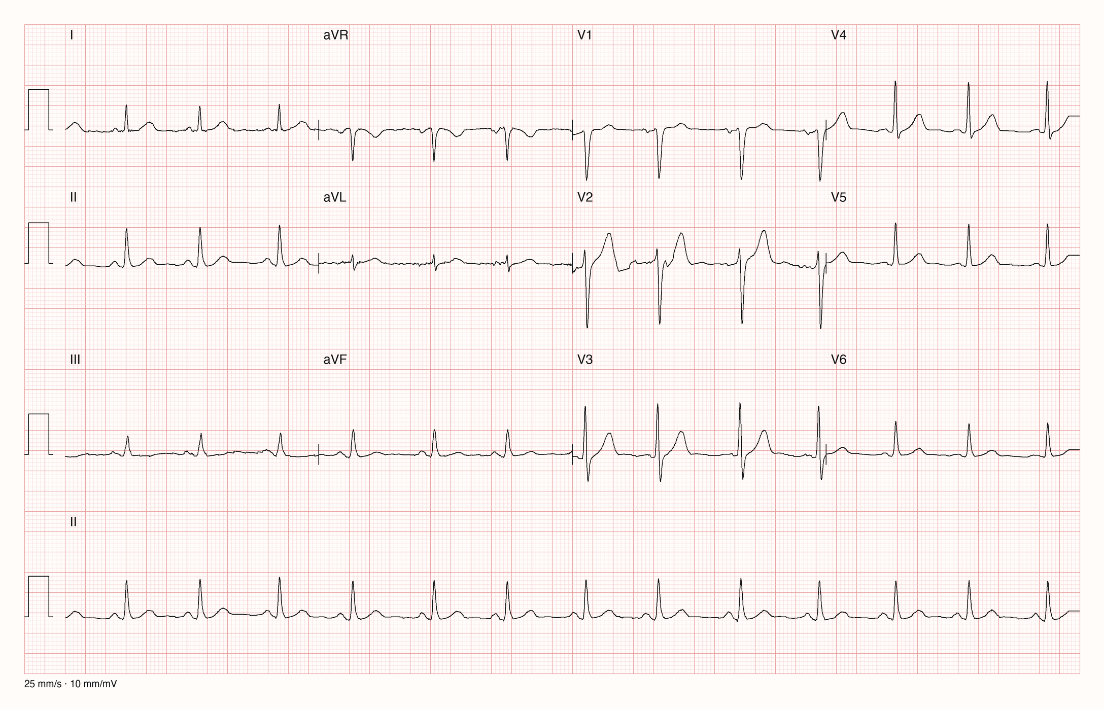 12-Kanal-EKG mit Rhythmusstreifen II, 25 mm/s, 10 mm/mV, als Übungsaufnahme für einen vollständigen schriftlichen Befund