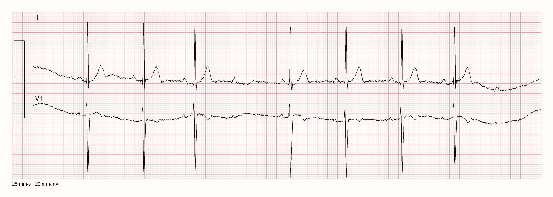 Rhythmusstreifen in Ableitung II und V1 über 10 Sekunden bei 20 mm/mV: regelmäßig aufeinanderfolgende P-Wellen; in der Mitte folgt auf eine P-Welle kein QRS-Komplex, sodass eine längere Pause entsteht