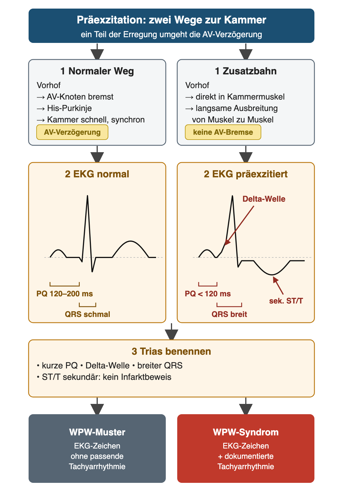 Vergleich normaler AV-Weg mit Verzögerung und Zusatzbahn ohne AV-Bremse; darunter schematisches EKG: normal mit PQ 120–200 ms und schmalem QRS, präexzitiert mit PQ unter 120 ms, Delta-Welle, breitem QRS und sekundär gegensinniger ST/T; Ergebnis WPW-Muster ohne und WPW-Syndrom mit dokumentierter Tachyarrhythmie