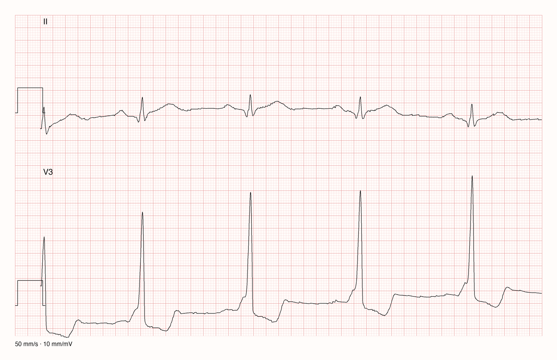 Ableitungen II und V3 über 4 s bei 50 mm/s: P-Welle in II, danach in V3 ein langsam ansteigender QRS-Beginn vor dem steilen R; PQ etwa 0,11 s, QRS etwa 0,12–0,13 s; Präexzitationsmuster
