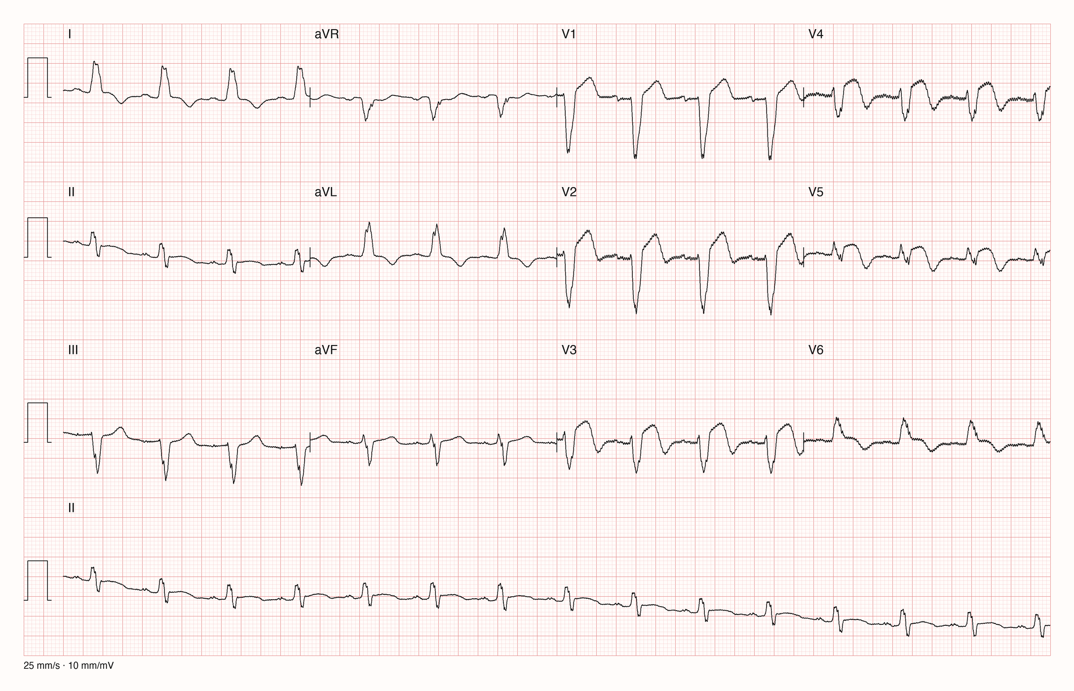12-Kanal-EKG patient091/s0353lre; zur systematischen Befundung