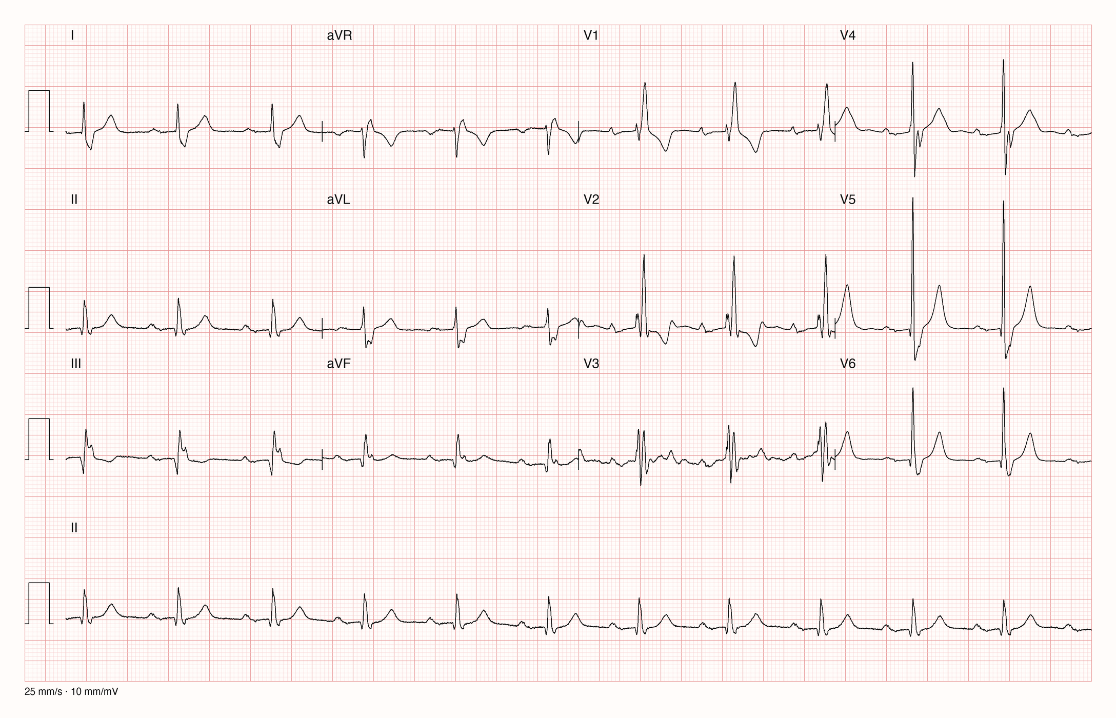 12-Kanal-EKG patient205/s0426_re; zur systematischen Befundung