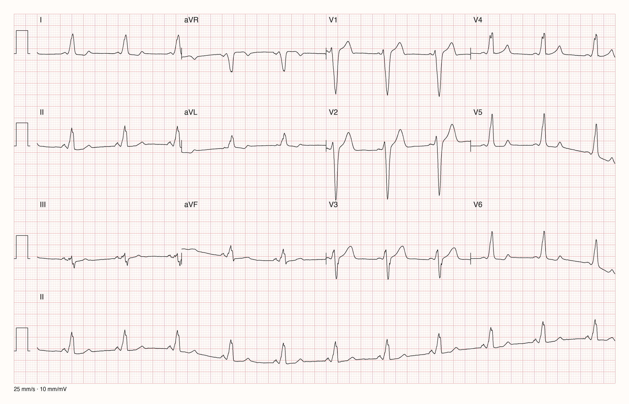 12-Kanal-EKG patient207/s0428_re; zur systematischen Befundung