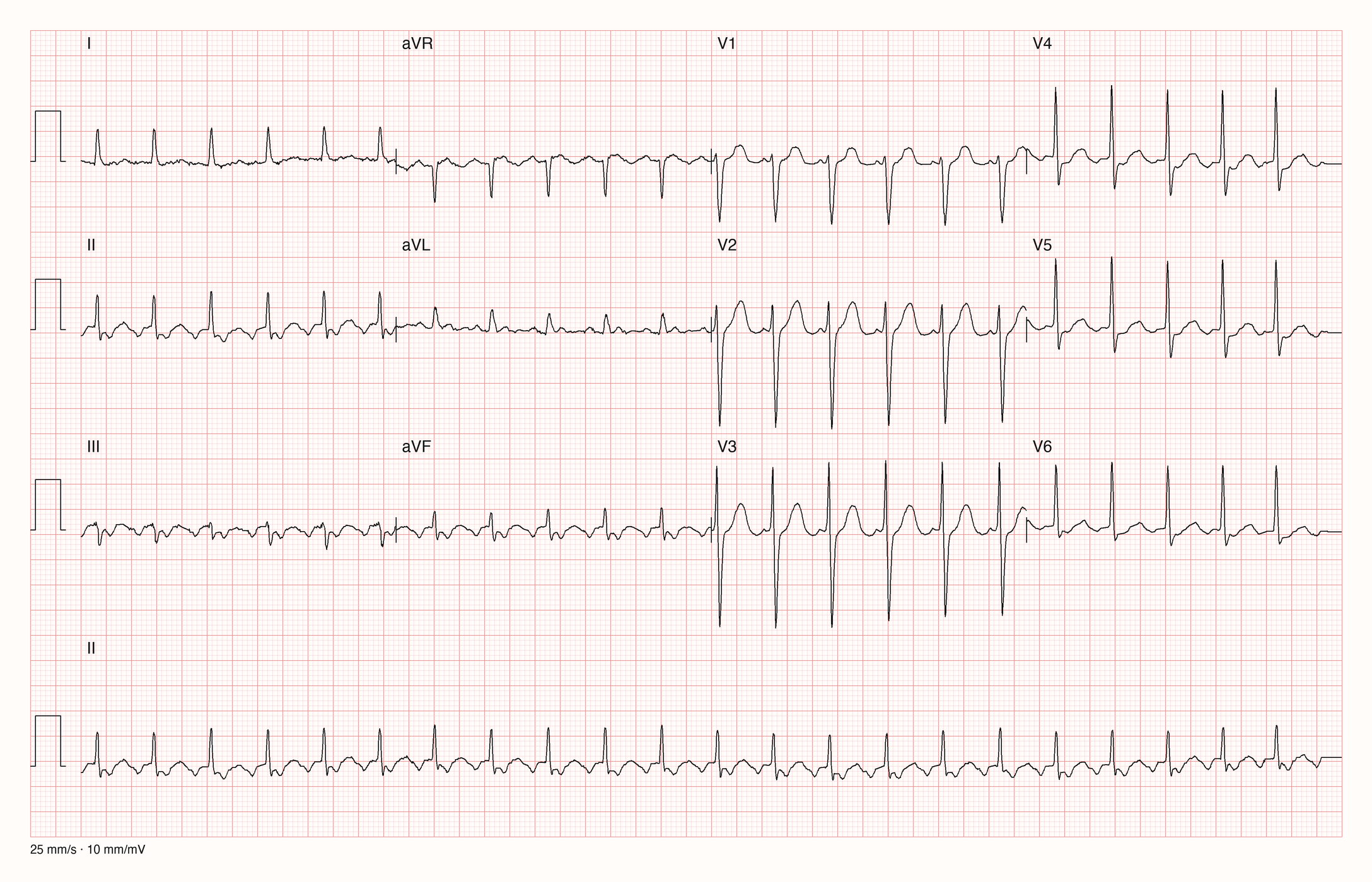 12-Kanal-EKG mit Rhythmusstreifen II, Datensatzkennung 10160