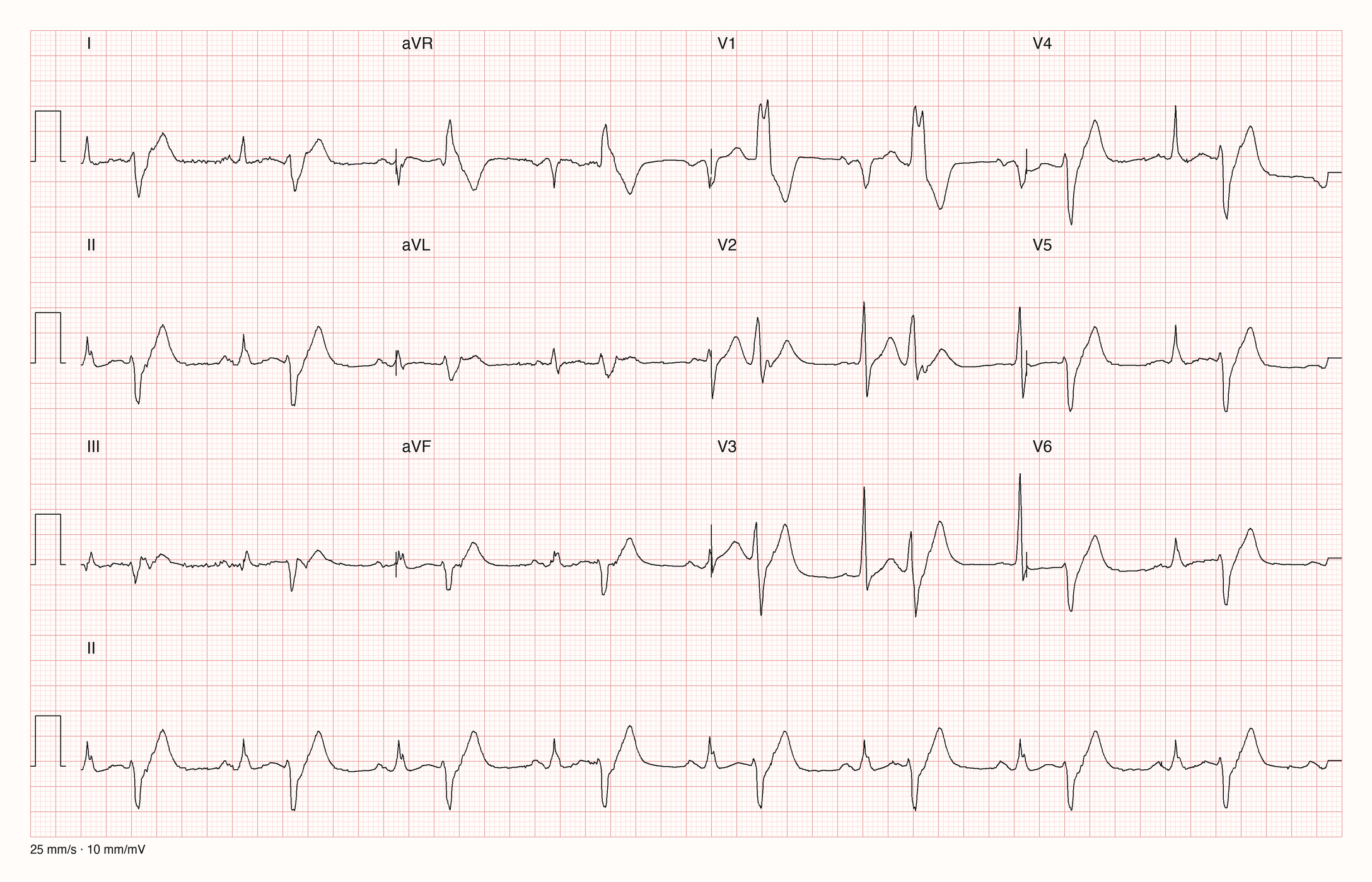 12-Kanal-EKG mit Rhythmusstreifen II, Datensatzkennung 10355