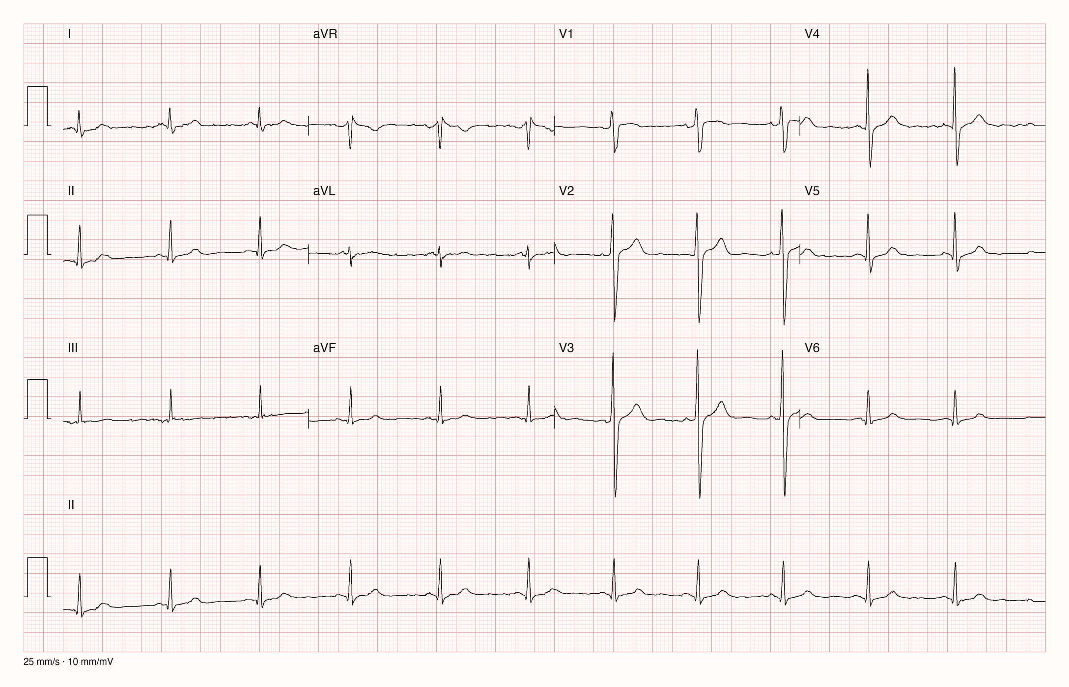 12-Kanal-EKG mit Rhythmusstreifen II, Datensatzkennung 1113