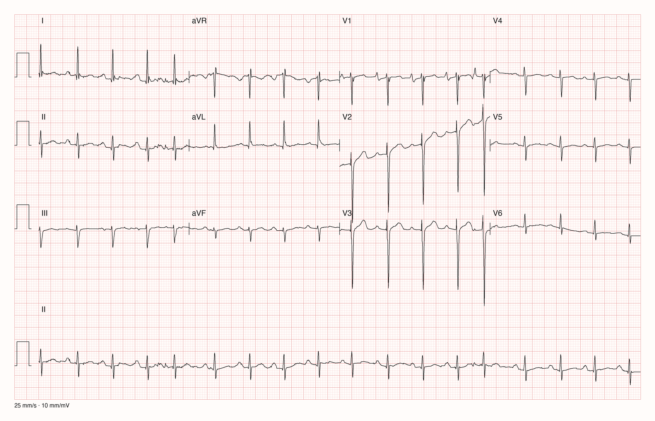 12-Kanal-EKG mit Rhythmusstreifen II, Datensatzkennung 1158