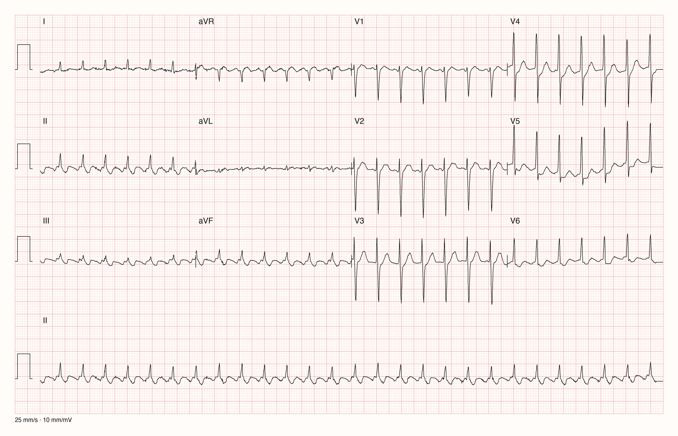 12-Kanal-EKG mit Rhythmusstreifen II, Datensatzkennung 1173