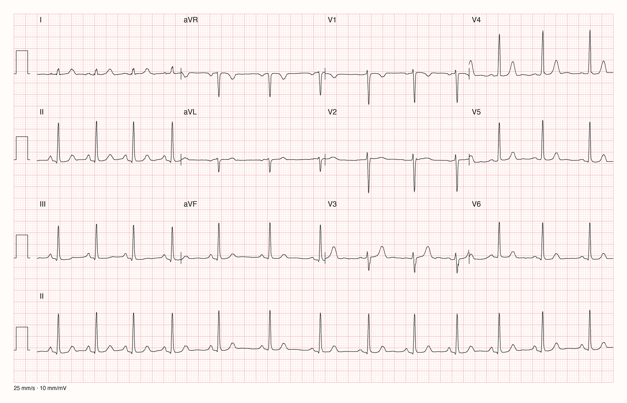 12-Kanal-EKG mit Rhythmusstreifen II, Datensatzkennung 1197
