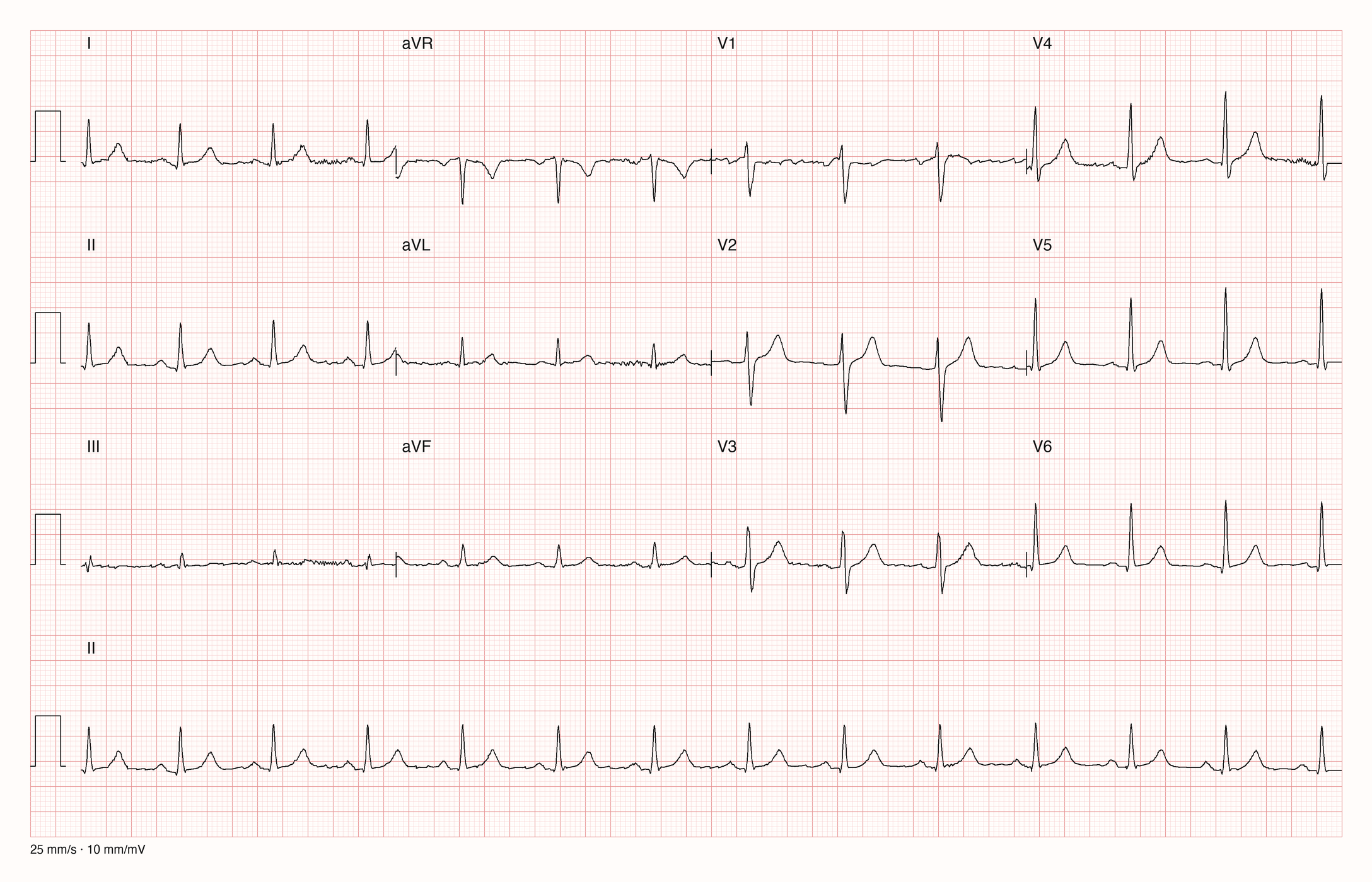 12-Kanal-EKG mit Rhythmusstreifen II, Datensatzkennung 1208