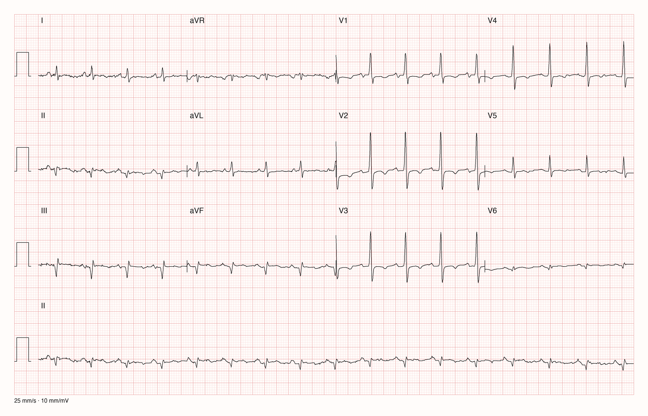 12-Kanal-EKG mit Rhythmusstreifen II, Datensatzkennung 12173