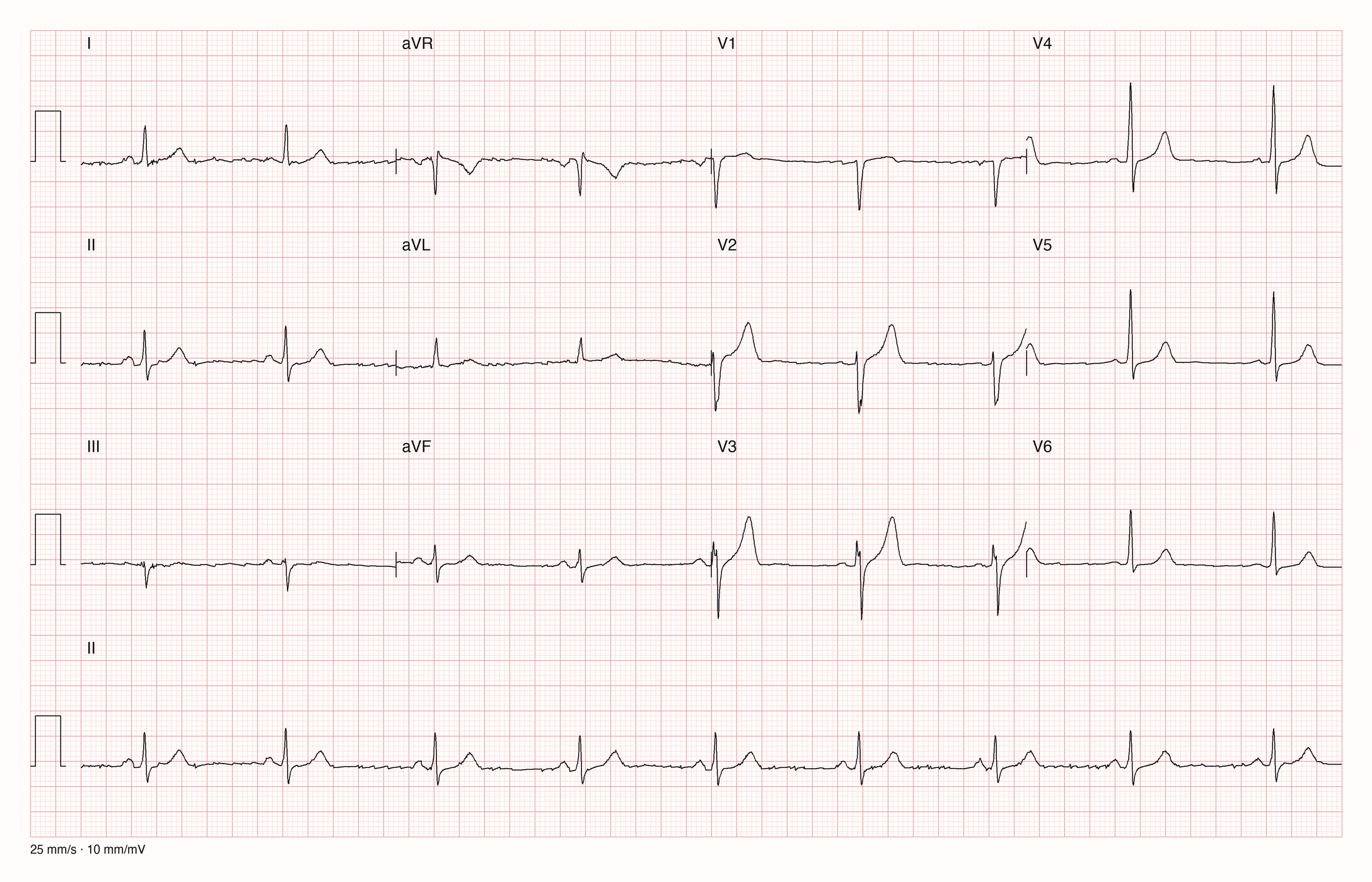 12-Kanal-EKG mit Rhythmusstreifen II, Datensatzkennung 1246