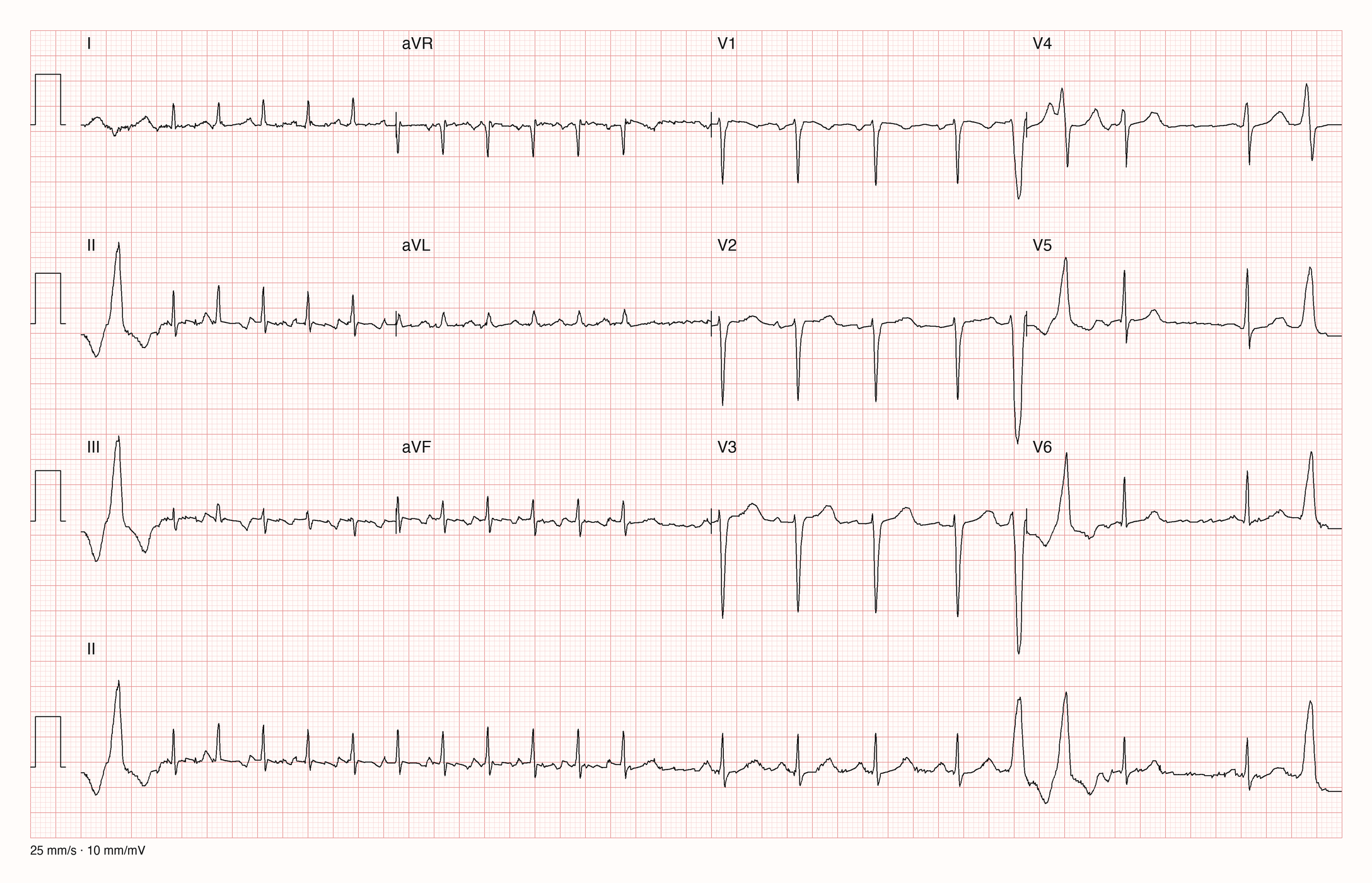 12-Kanal-EKG mit Rhythmusstreifen II, Datensatzkennung 12537