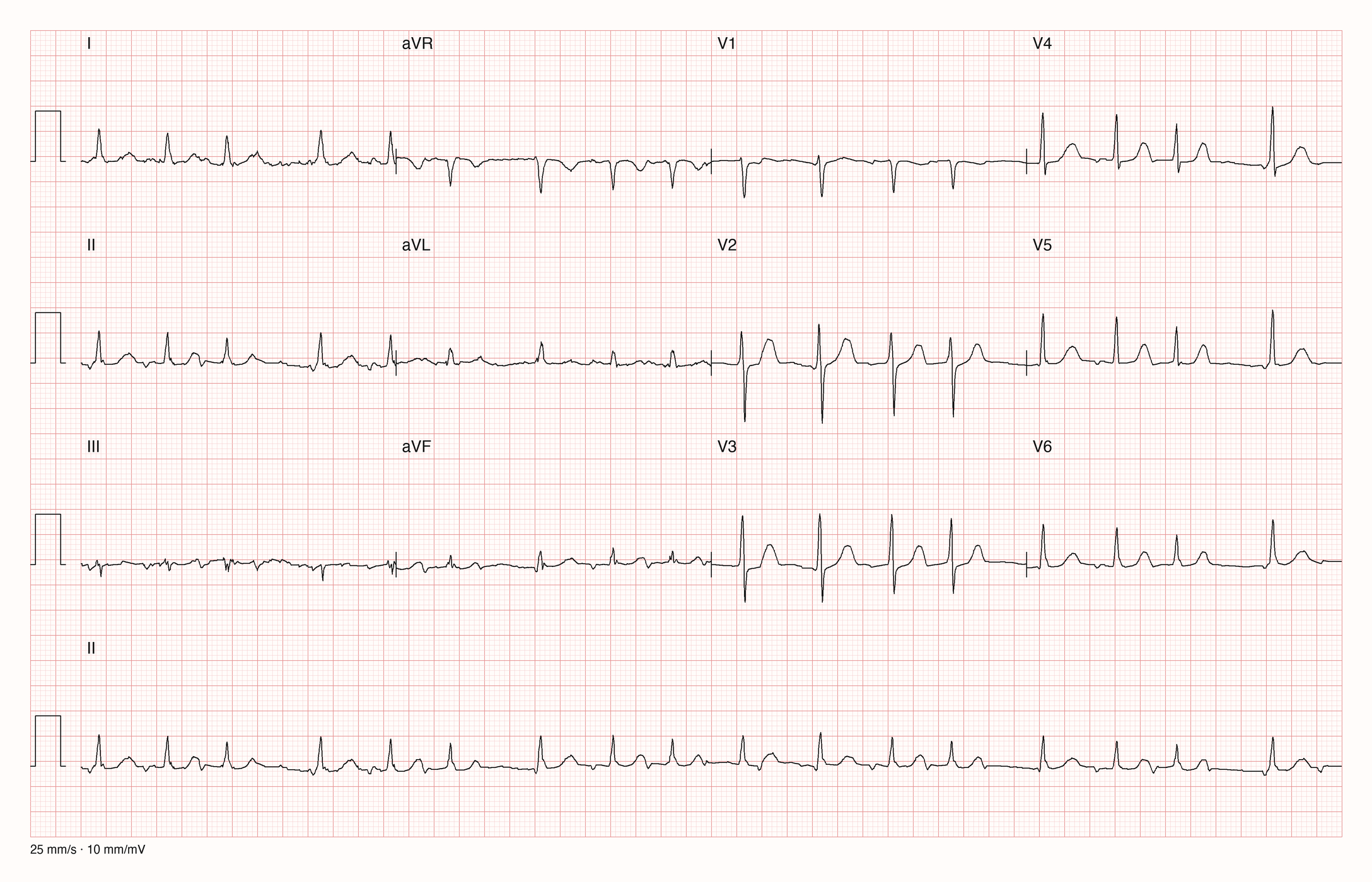 12-Kanal-EKG mit Rhythmusstreifen II, Datensatzkennung 12632