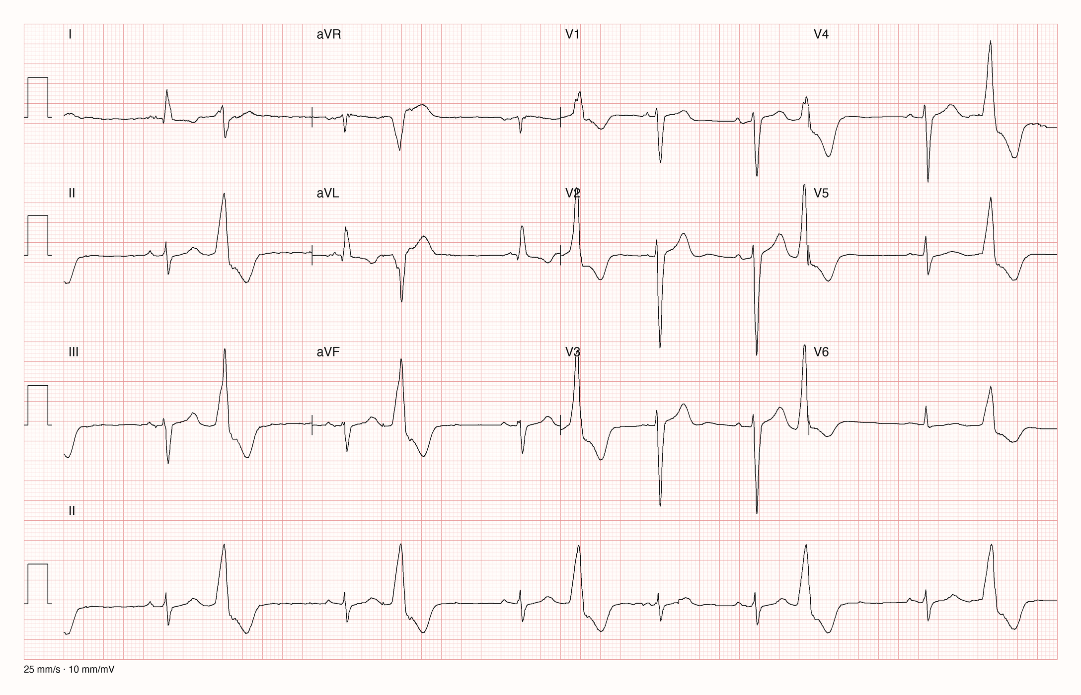 12-Kanal-EKG mit Rhythmusstreifen II, Datensatzkennung 12644