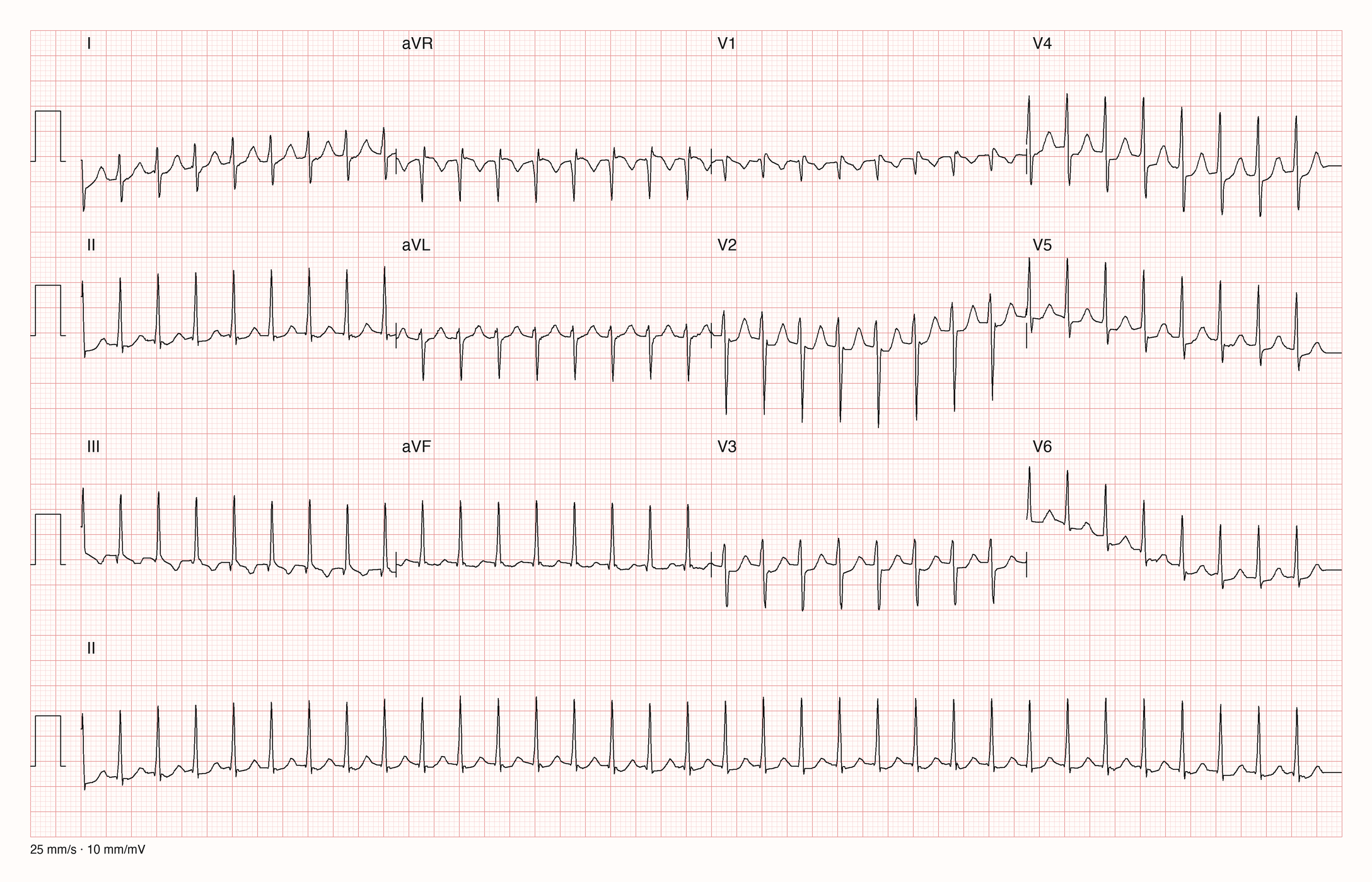 12-Kanal-EKG mit Rhythmusstreifen II, Datensatzkennung 14286