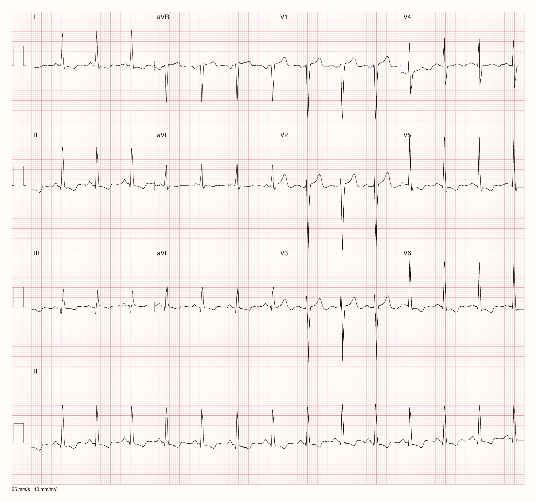 EKG-Aufnahme PTBXL-1451; beurteile zunächst selbst die sichtbare Kurve