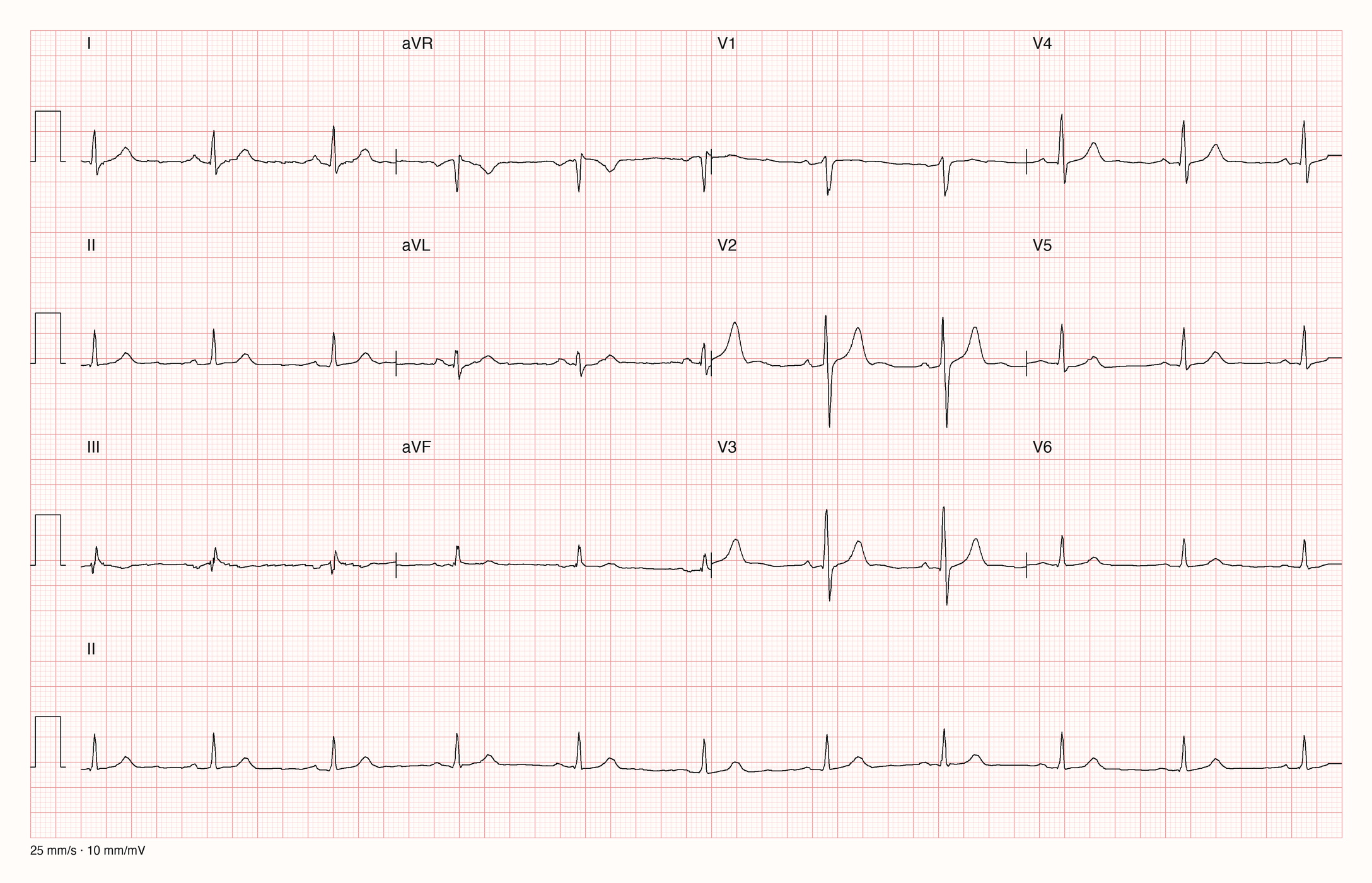 12-Kanal-EKG mit Rhythmusstreifen II, Datensatzkennung 1479
