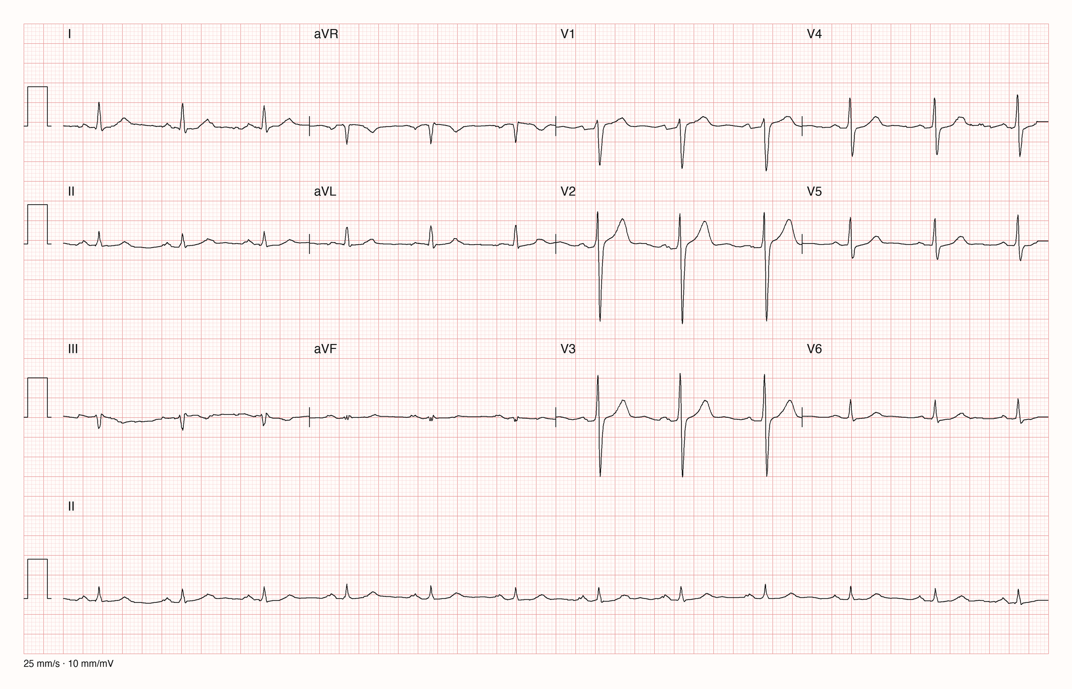 12-Kanal-EKG mit Rhythmusstreifen II, Datensatzkennung 1491