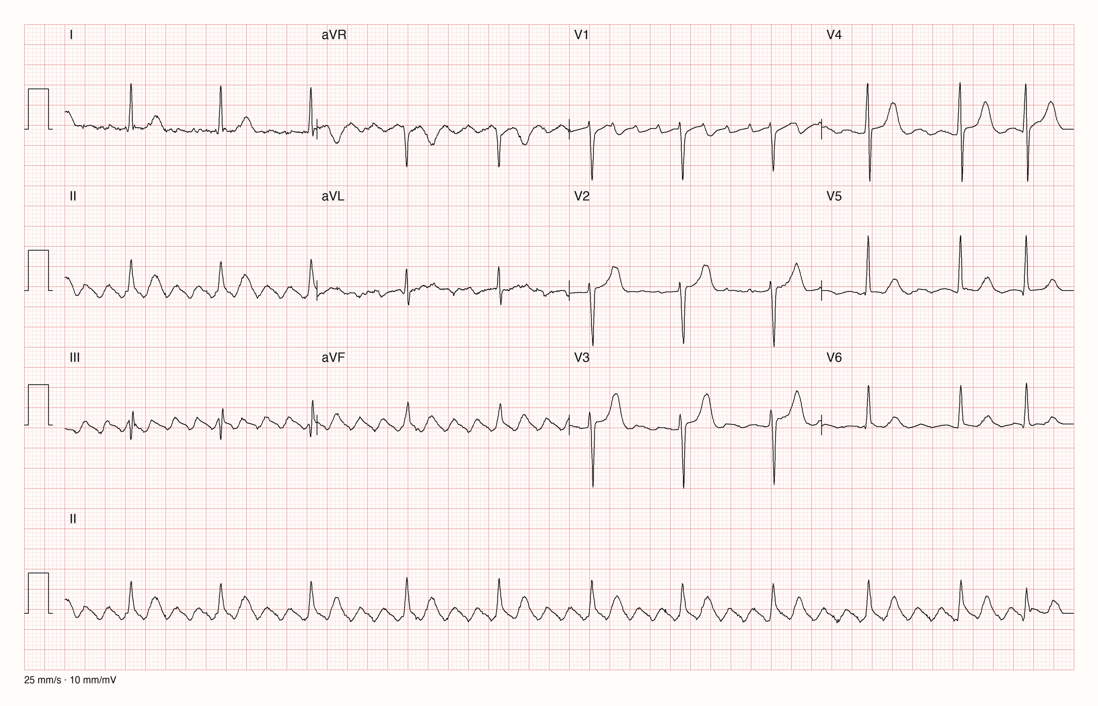 EKG-Aufnahme PTBXL-16401; beurteile zunächst selbst die sichtbare Kurve