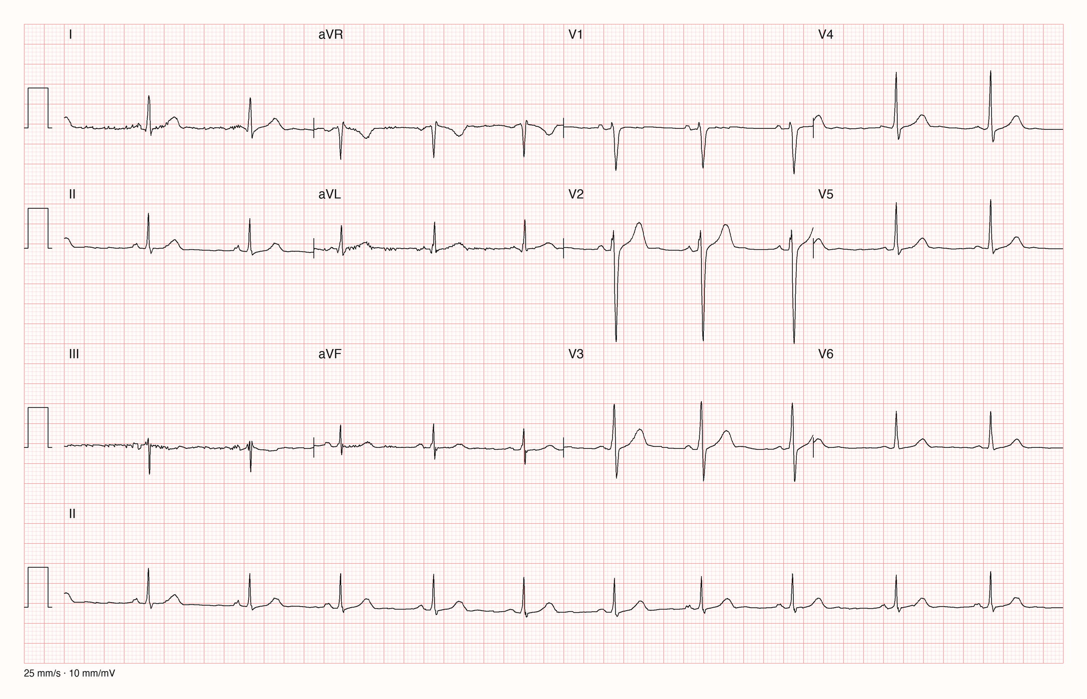 12-Kanal-EKG mit Rhythmusstreifen II, Datensatzkennung 165