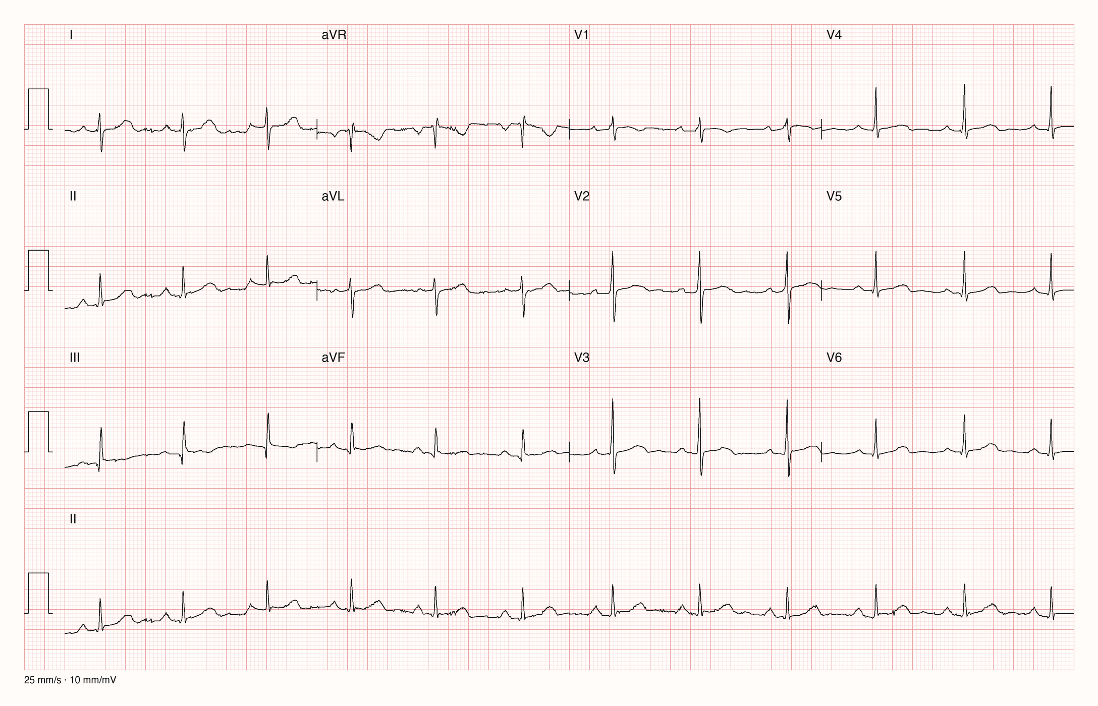 12-Kanal-EKG mit Rhythmusstreifen II, Datensatzkennung 18050