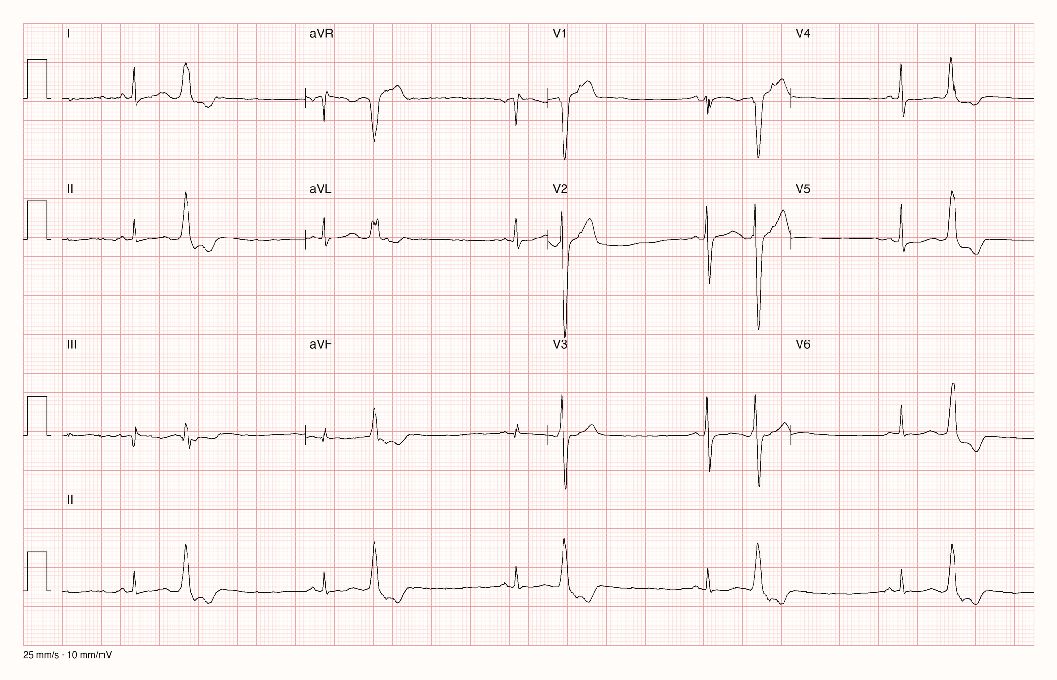 12-Kanal-EKG mit Rhythmusstreifen II, Datensatzkennung 18246