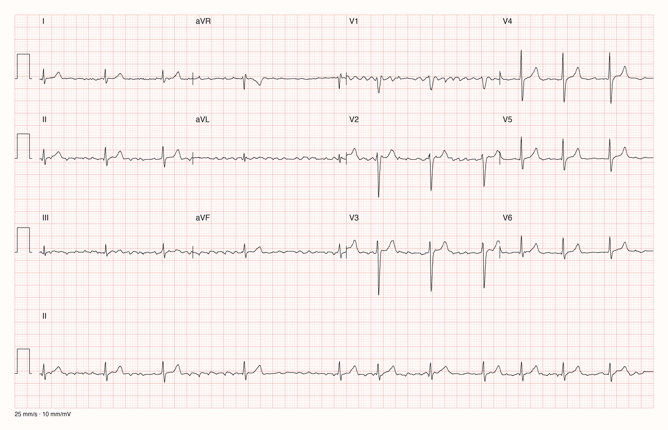 12-Kanal-EKG mit Rhythmusstreifen II, Datensatzkennung 20406