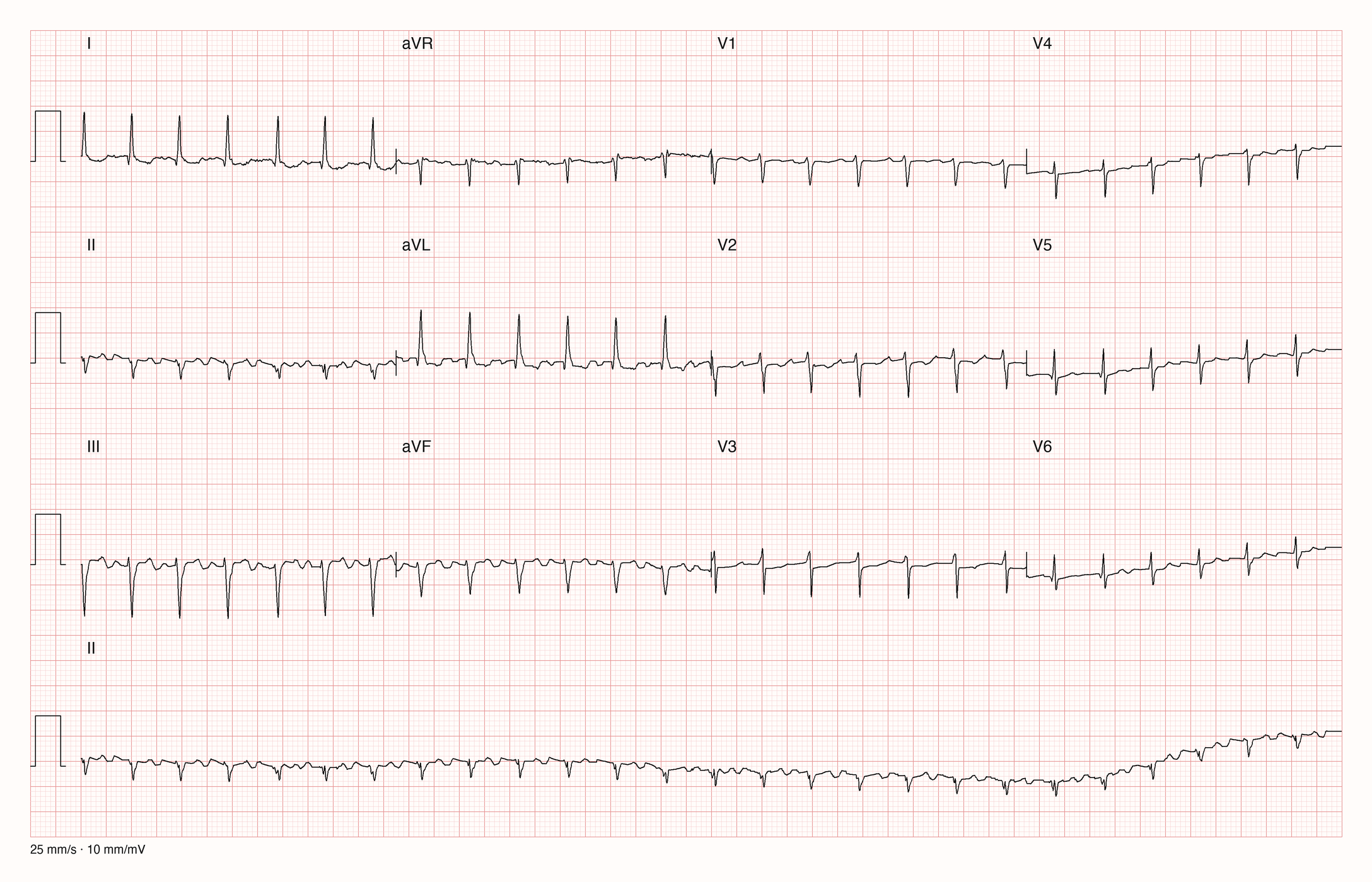 12-Kanal-EKG mit Rhythmusstreifen II, Datensatzkennung 2051