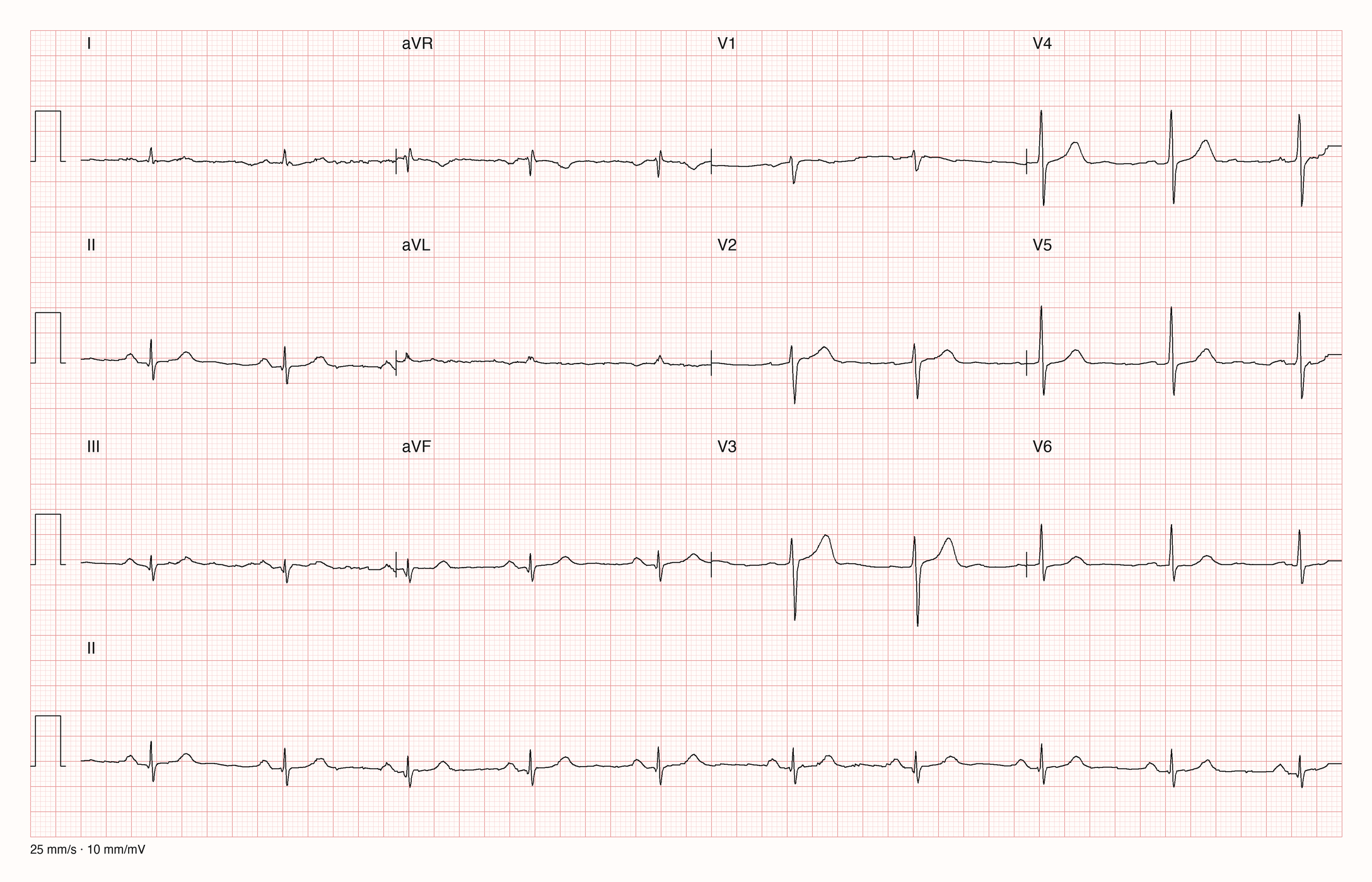 12-Kanal-EKG mit Rhythmusstreifen II, Datensatzkennung 2158