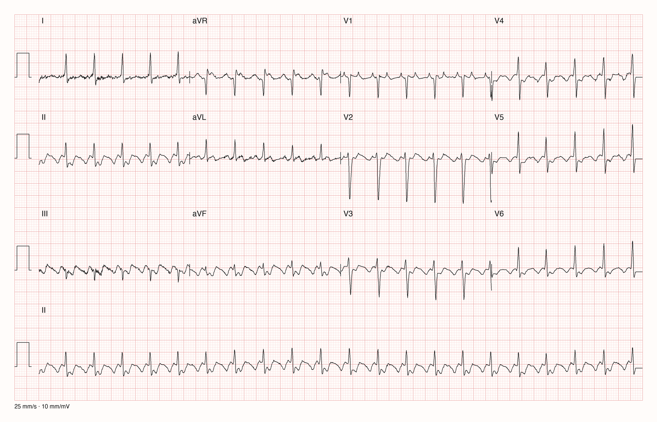 12-Kanal-EKG mit Rhythmusstreifen II, Datensatzkennung 23