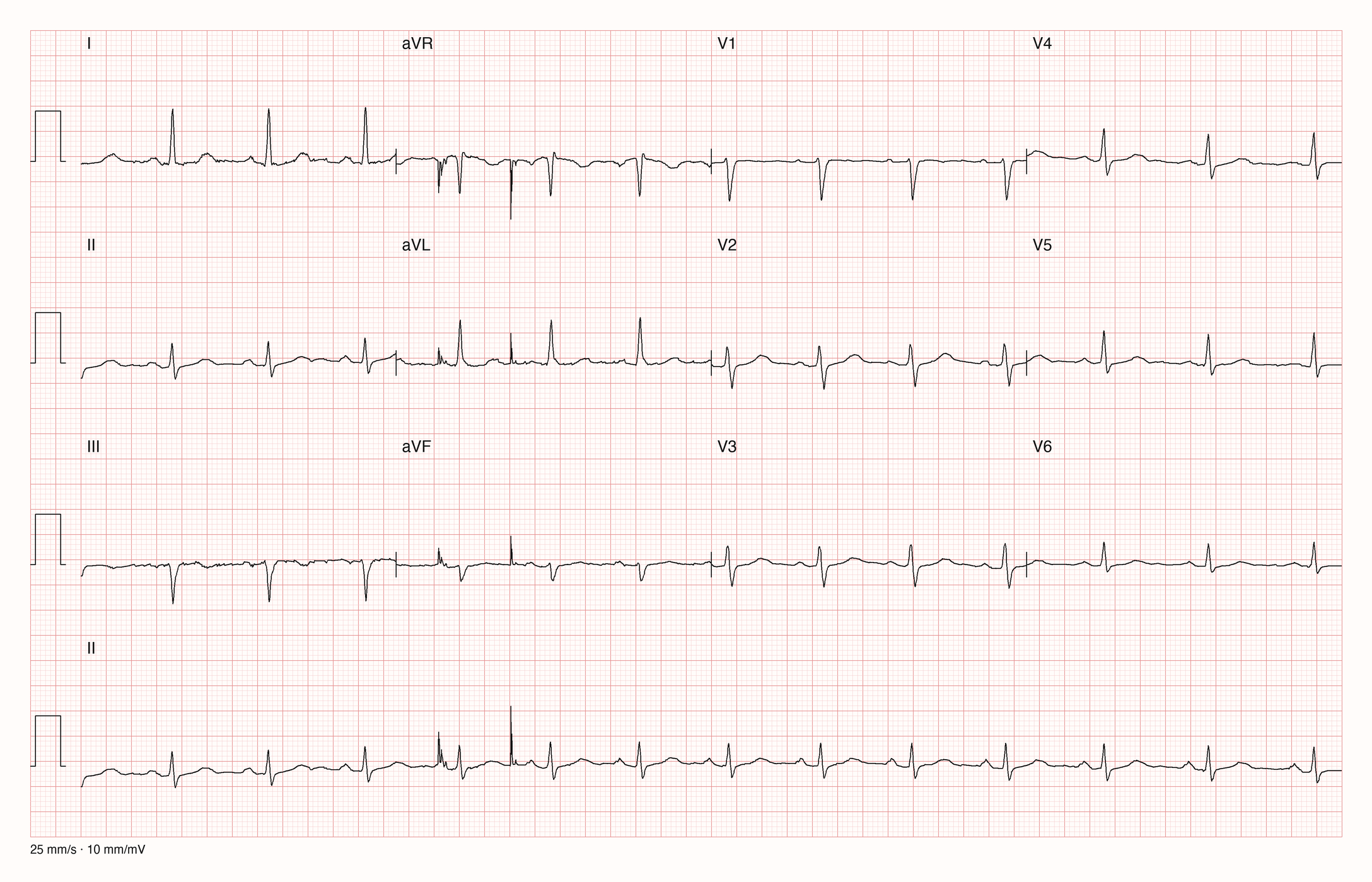 12-Kanal-EKG mit Rhythmusstreifen II, Datensatzkennung 2309