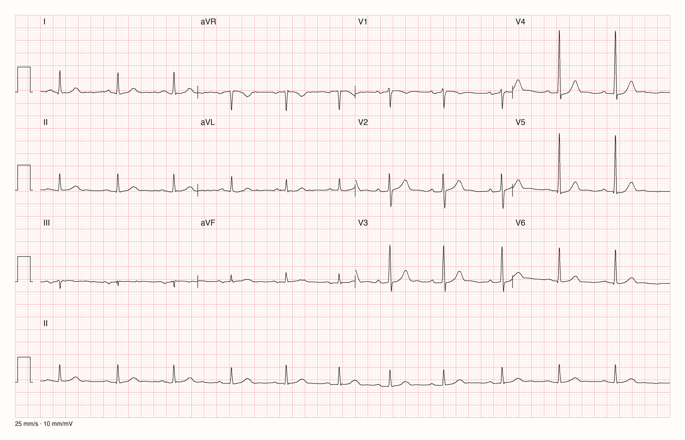 EKG-Aufnahme PTBXL-233; beurteile zunächst selbst die sichtbare Kurve