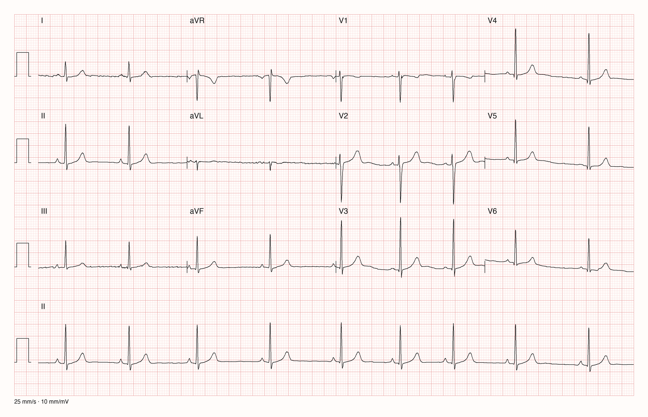 12-Kanal-EKG mit Rhythmusstreifen II, Datensatzkennung 2432