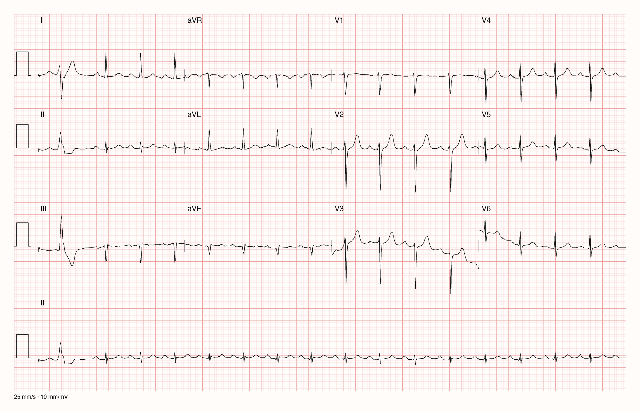 12-Kanal-EKG mit Rhythmusstreifen II, Datensatzkennung 2455