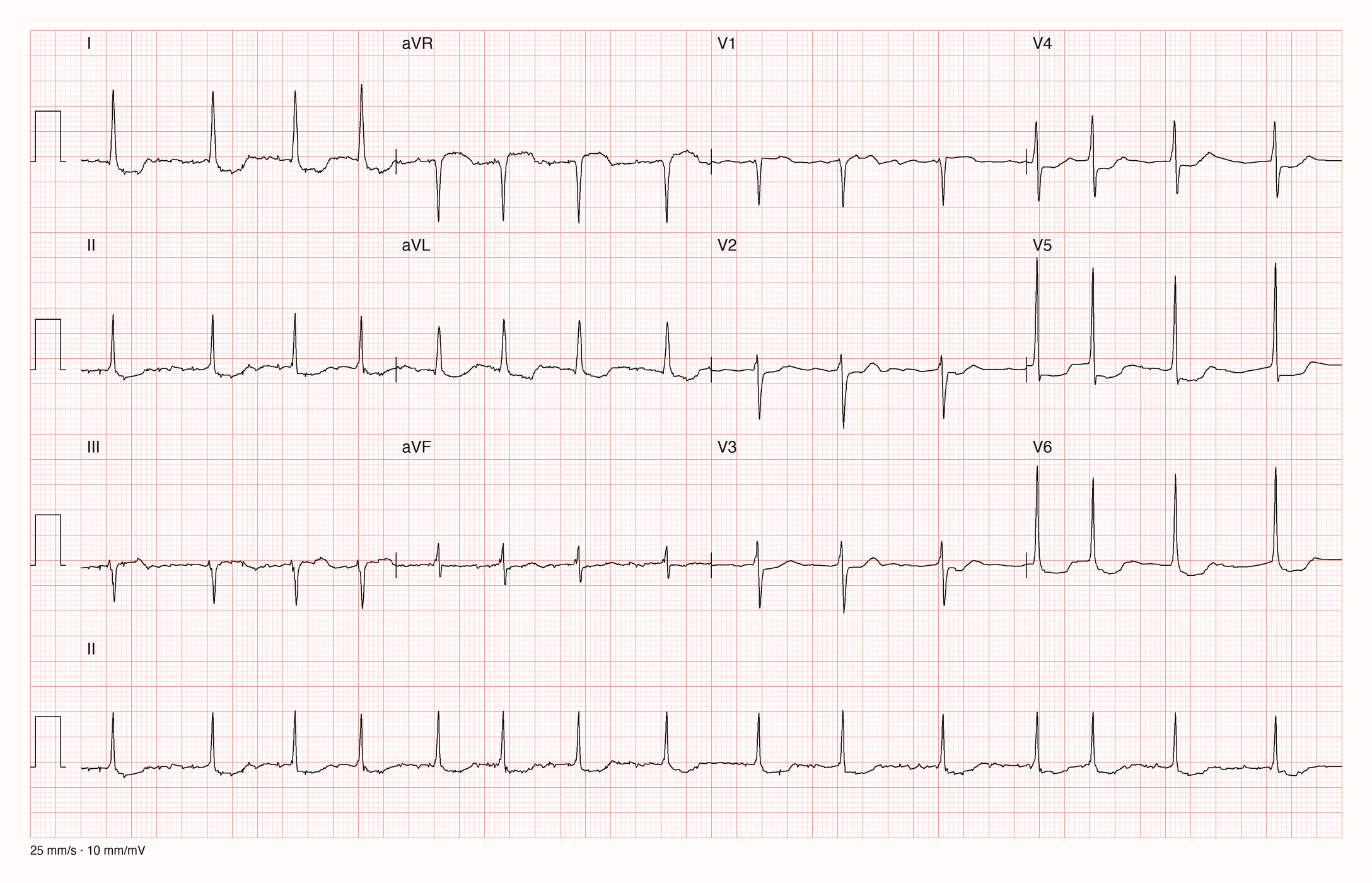 12-Kanal-EKG mit Rhythmusstreifen II, Datensatzkennung 2886