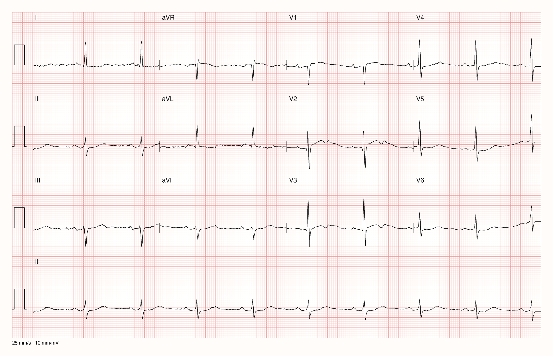 EKG-Aufnahme PTBXL-320; beurteile zunächst selbst die sichtbare Kurve