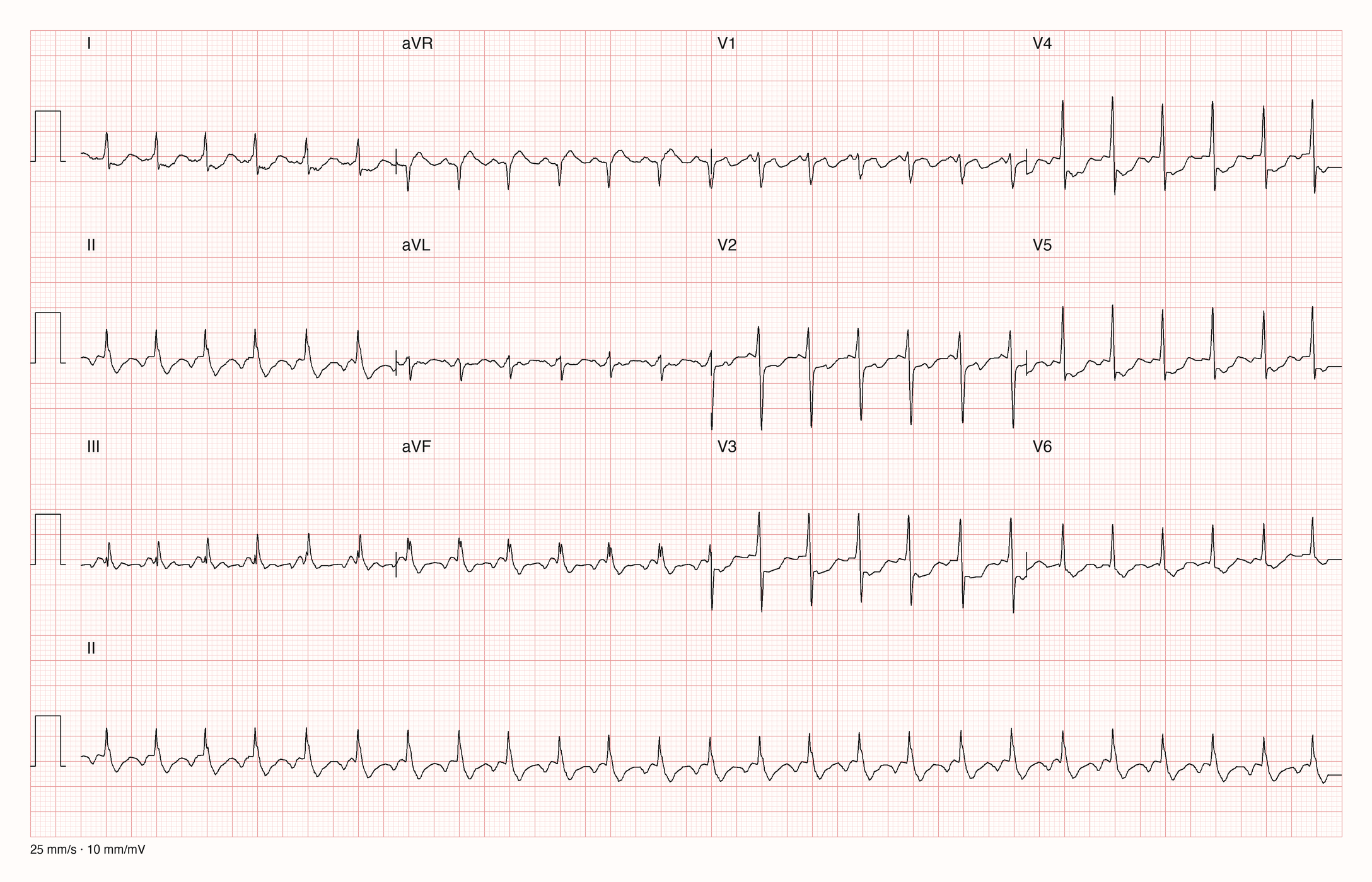 12-Kanal-EKG mit Rhythmusstreifen II, Datensatzkennung 3505