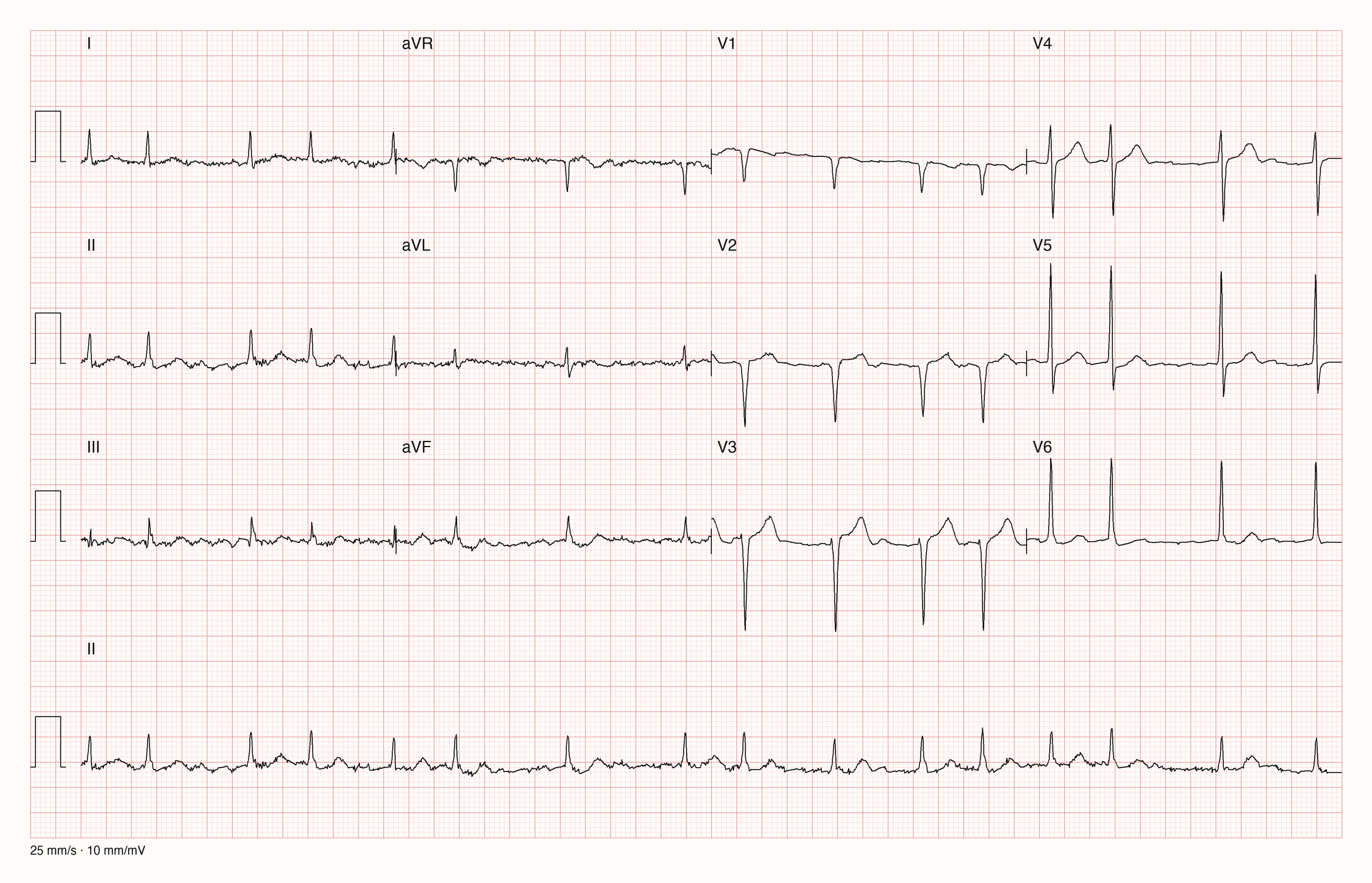 12-Kanal-EKG mit Rhythmusstreifen II, Datensatzkennung 3544