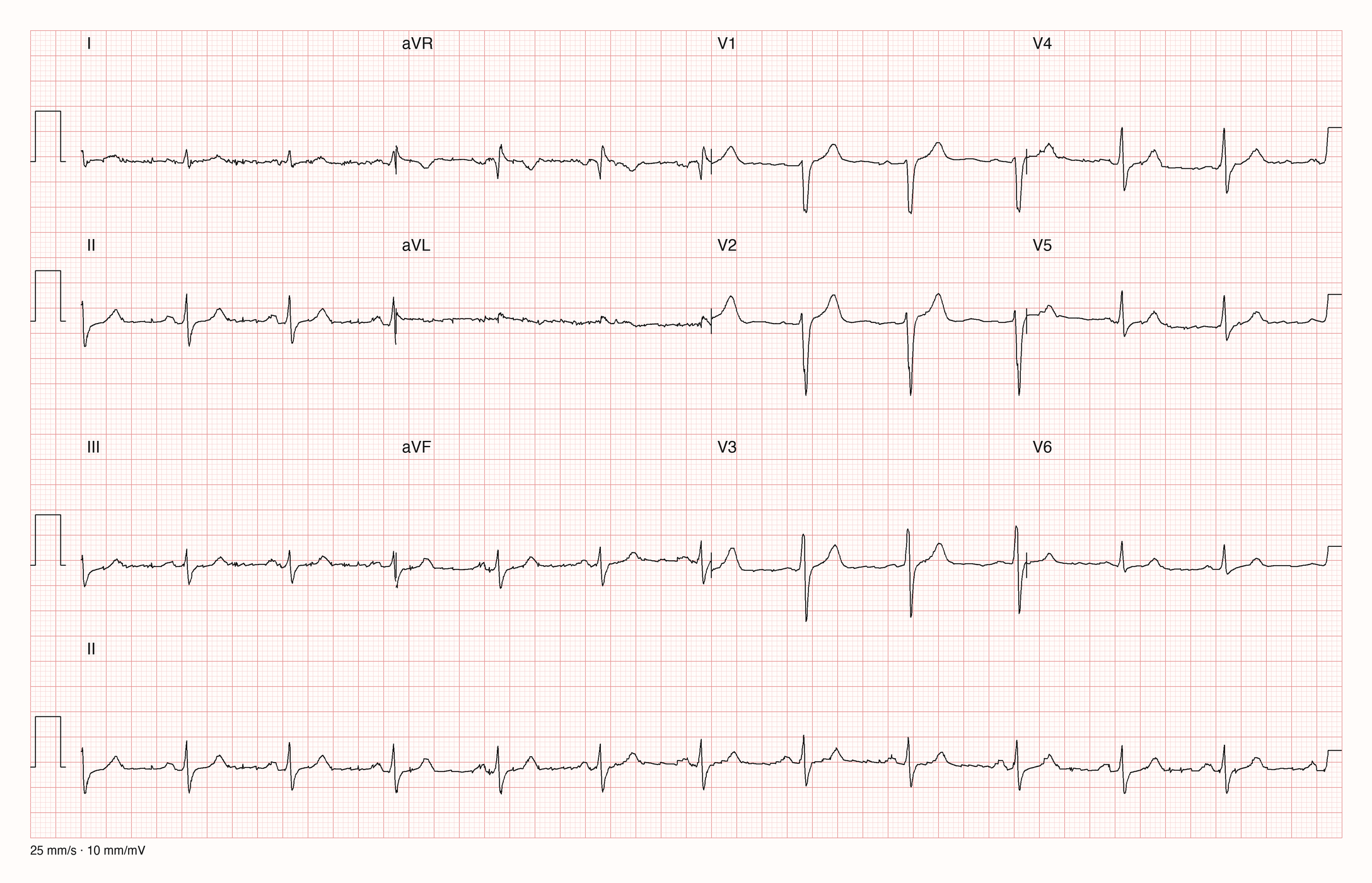 12-Kanal-EKG mit Rhythmusstreifen II, Datensatzkennung 38