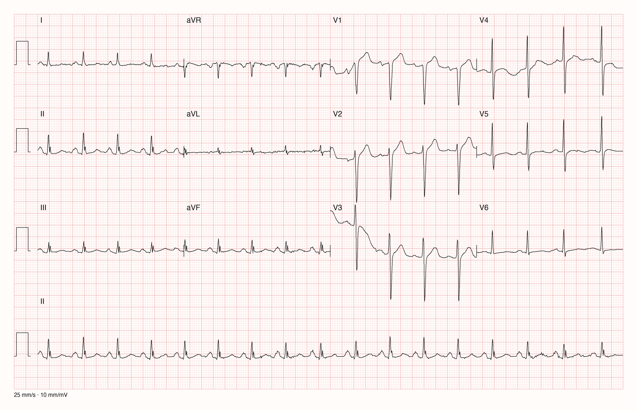 12-Kanal-EKG mit Rhythmusstreifen II, Datensatzkennung 4005