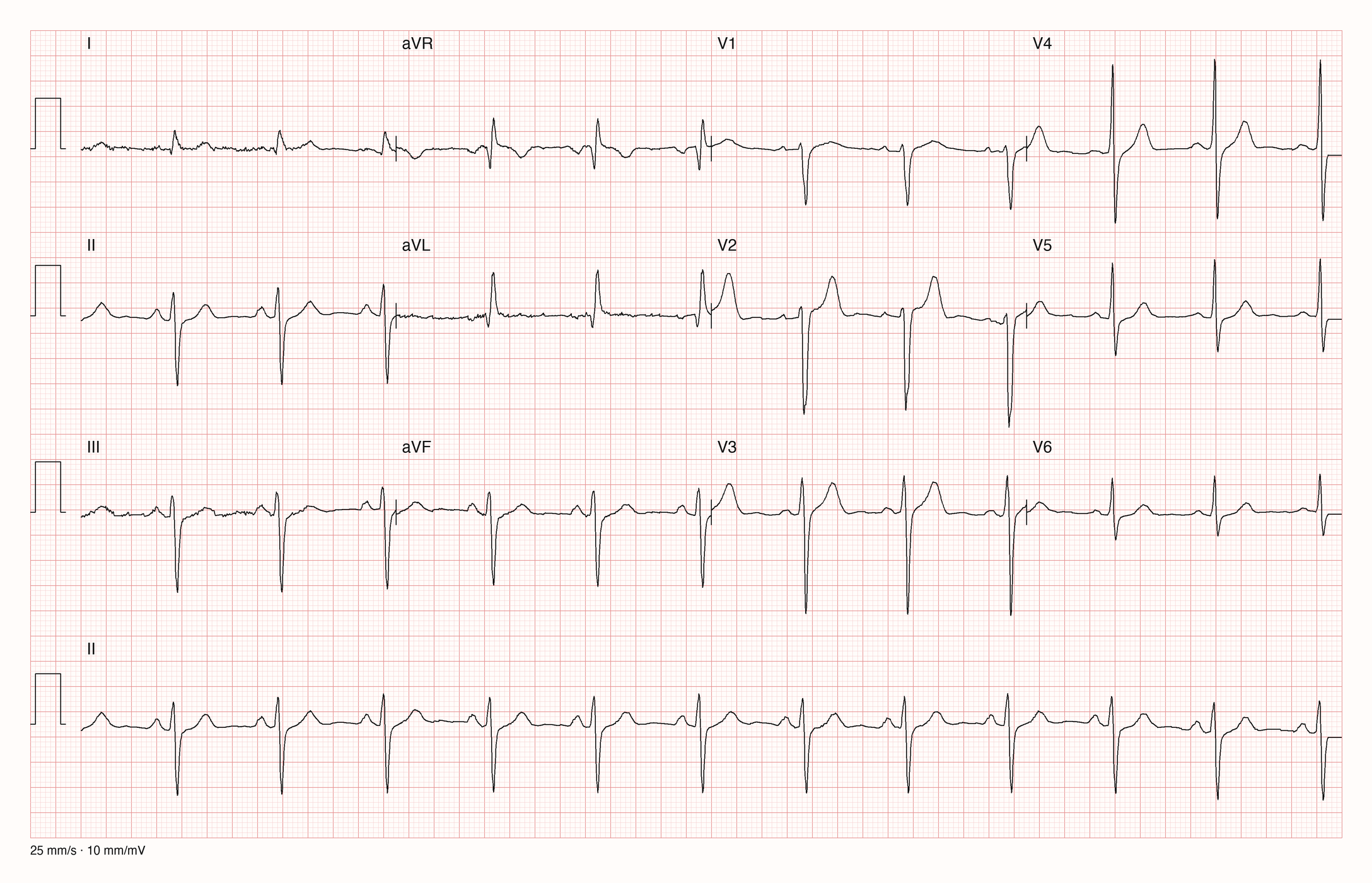12-Kanal-EKG mit Rhythmusstreifen II, Datensatzkennung 41