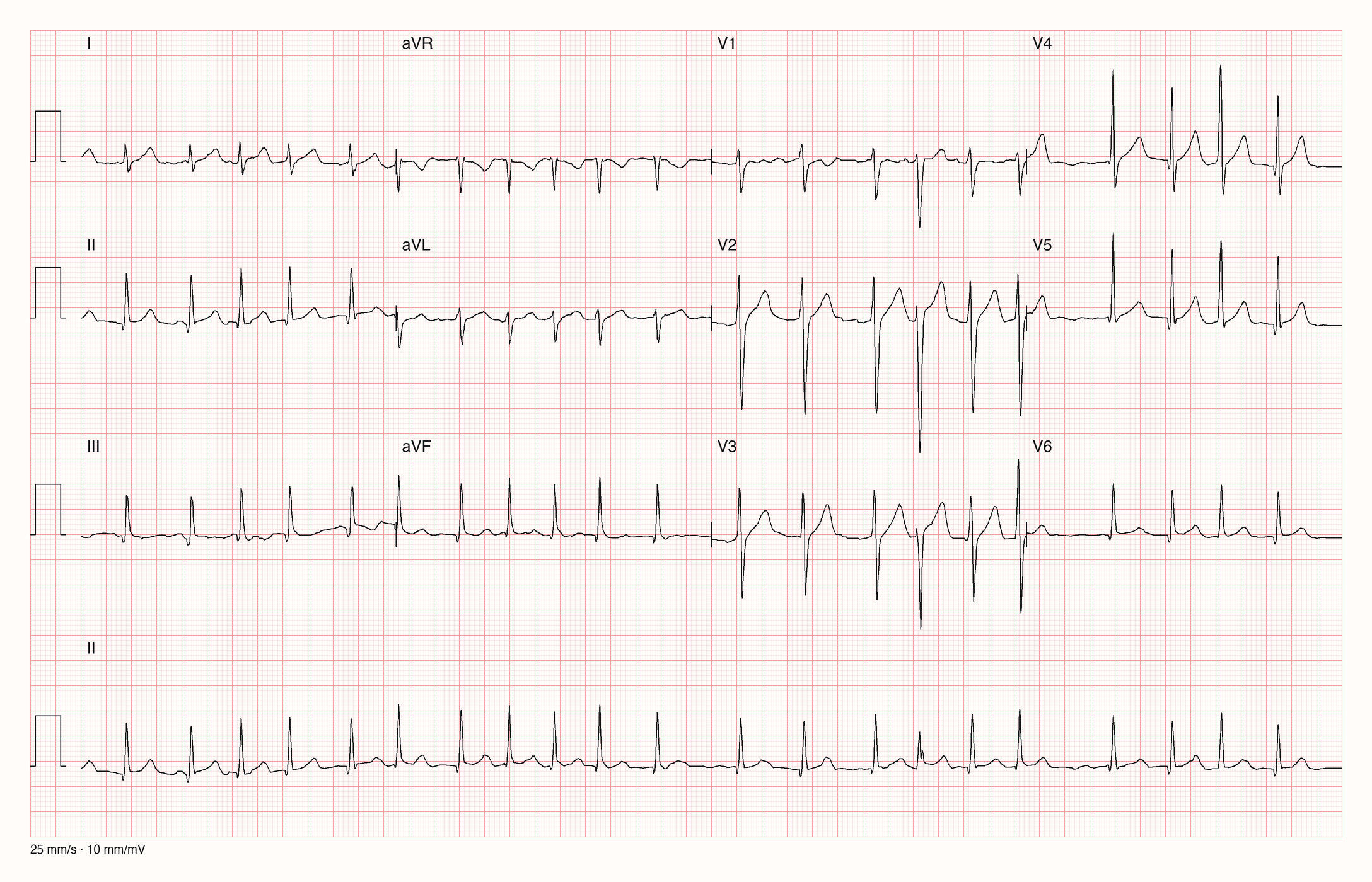 EKG-Aufnahme PTBXL-4117; beurteile zunächst selbst die sichtbare Kurve