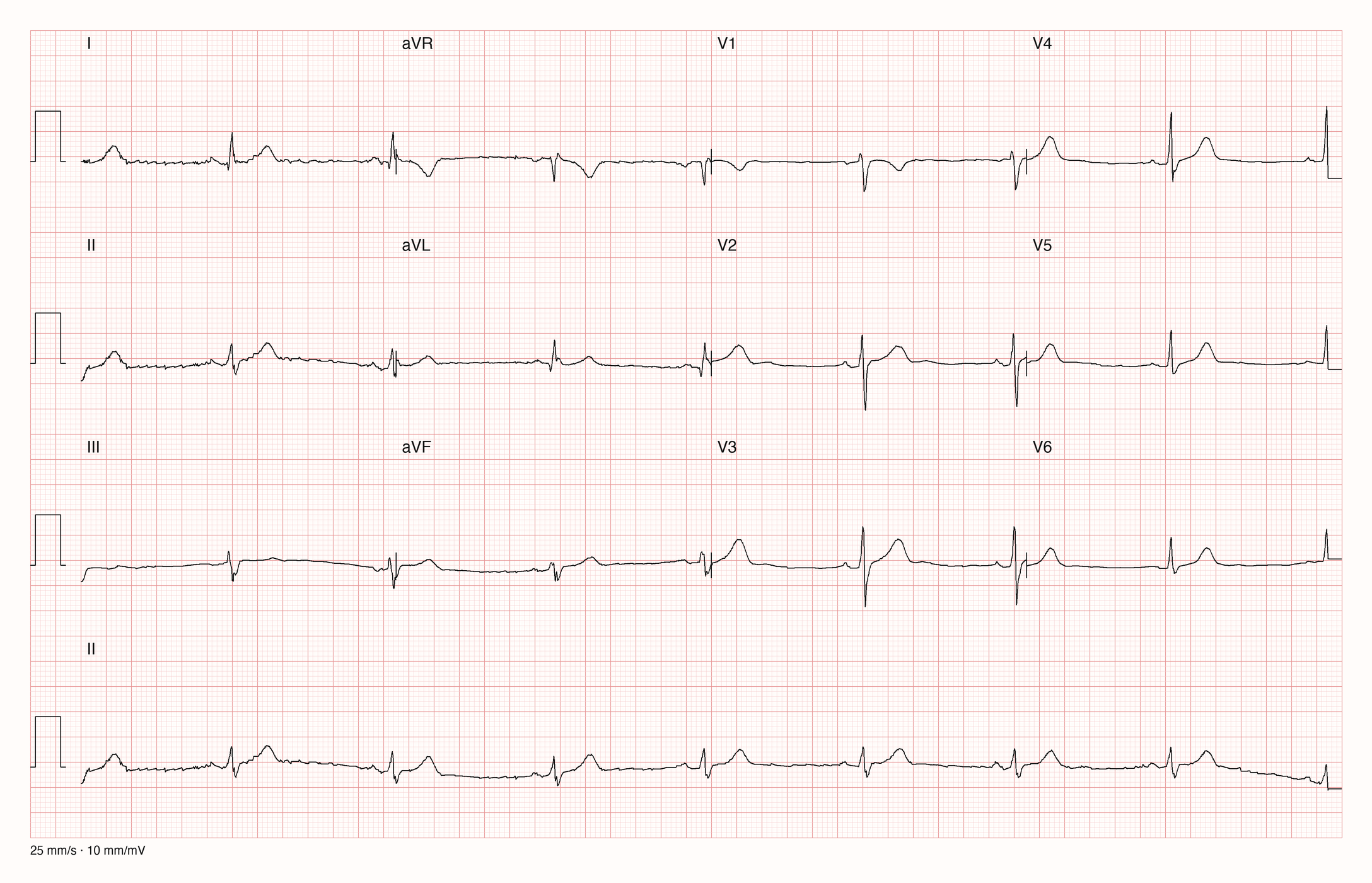 12-Kanal-EKG mit Rhythmusstreifen II, Datensatzkennung 4235
