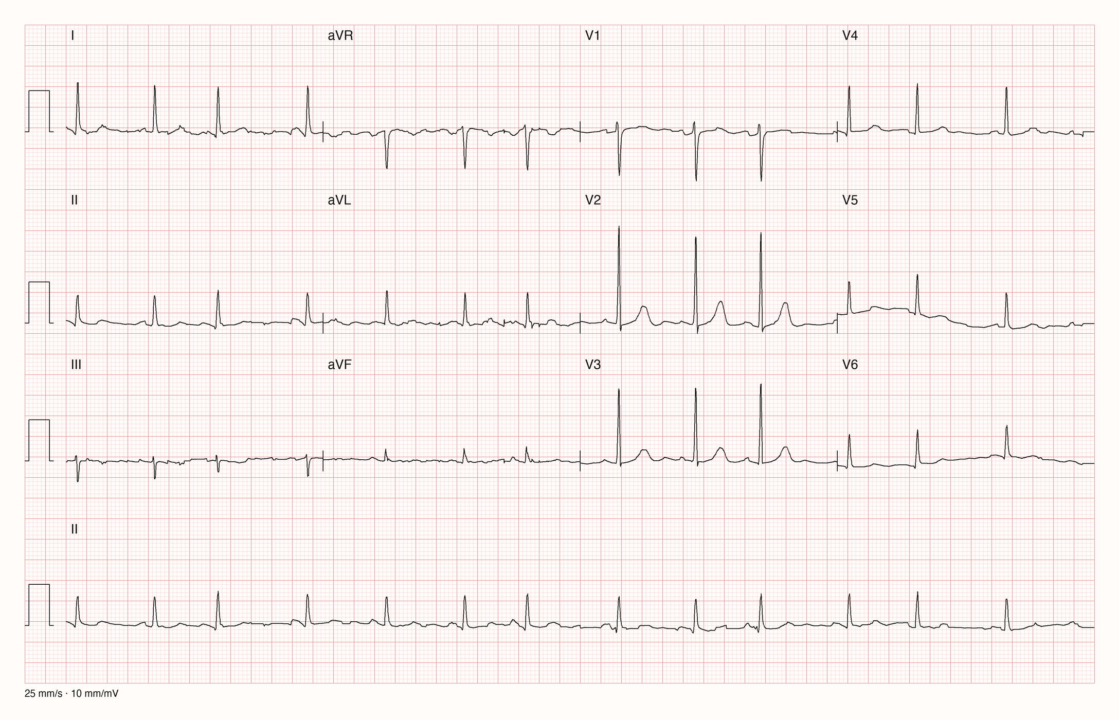12-Kanal-EKG mit Rhythmusstreifen II, Datensatzkennung 427