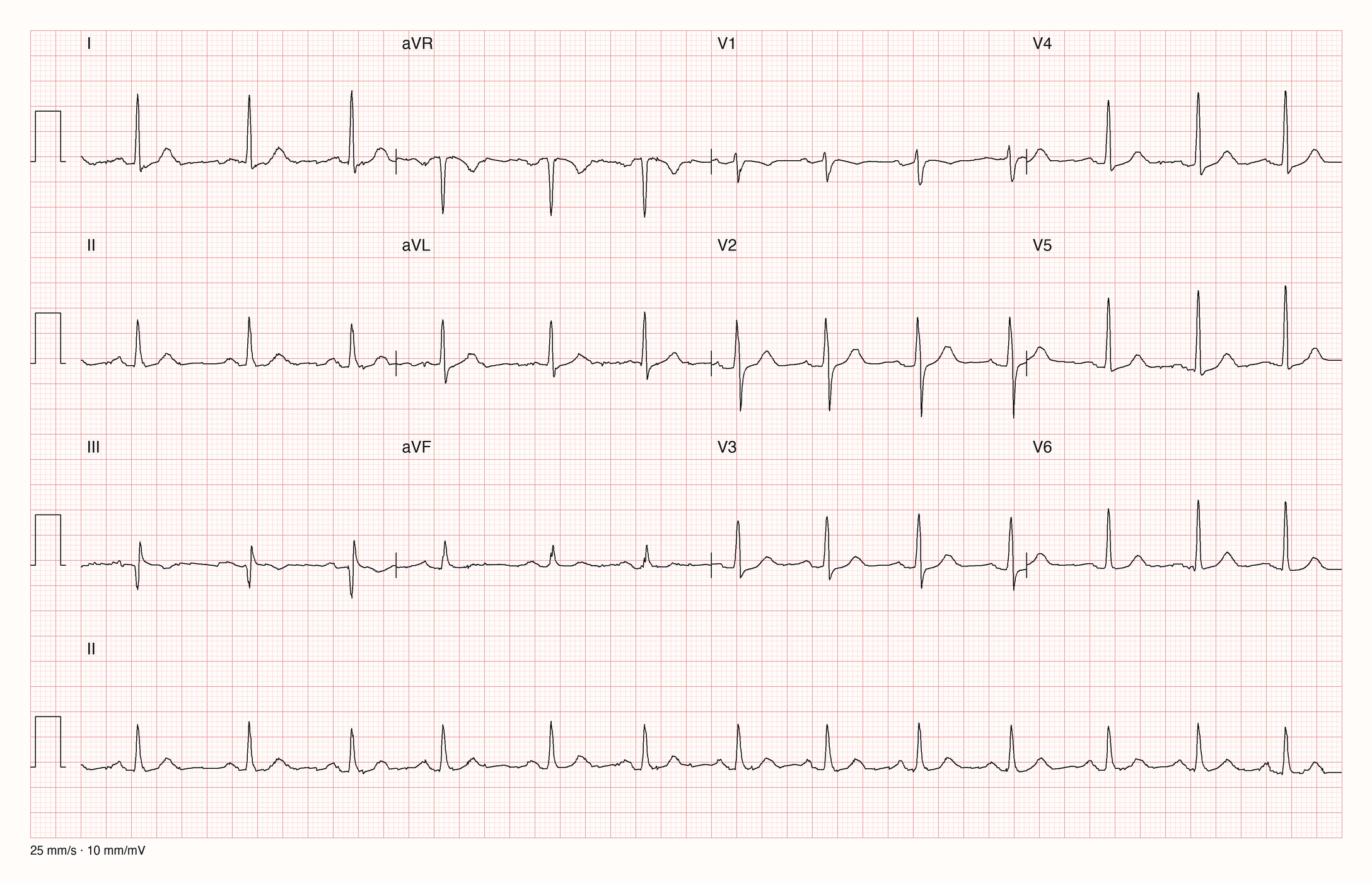 12-Kanal-EKG mit Rhythmusstreifen II, Datensatzkennung 440