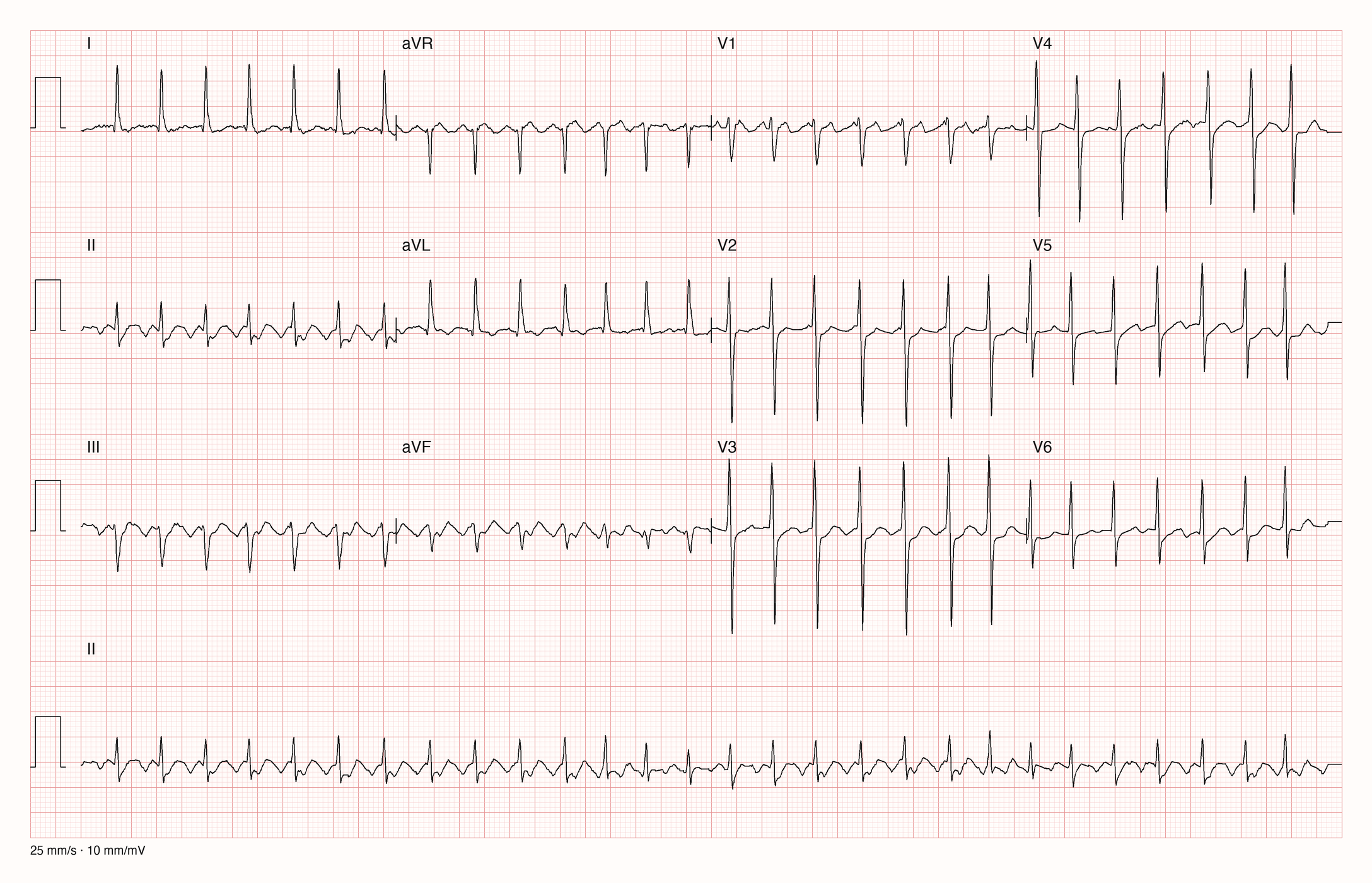 12-Kanal-EKG mit Rhythmusstreifen II, Datensatzkennung 449