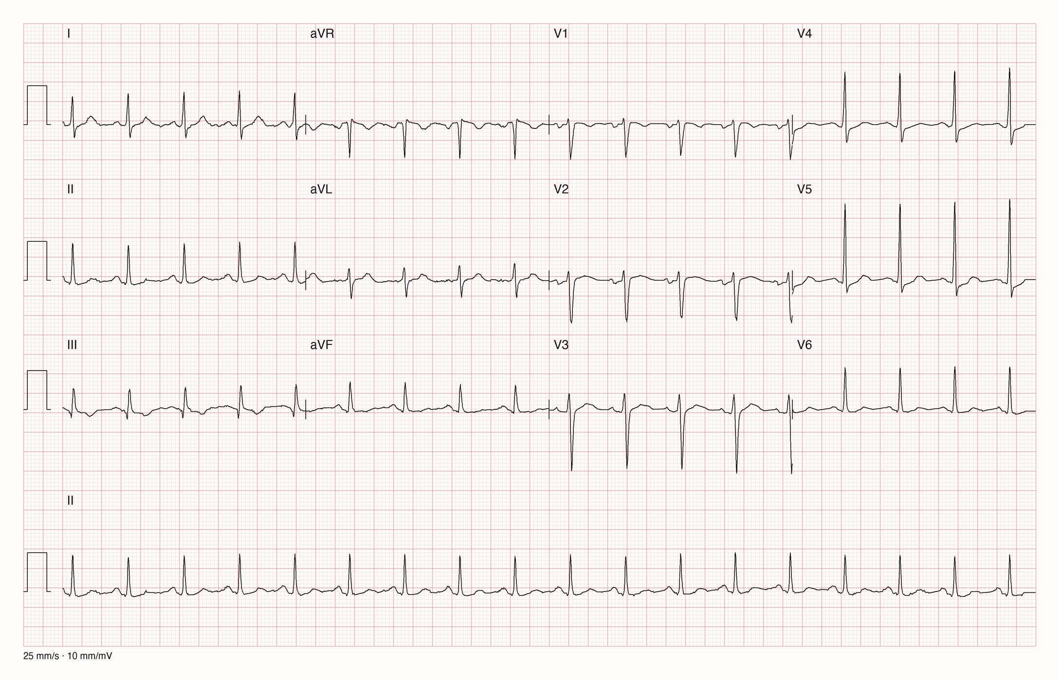 12-Kanal-EKG mit Rhythmusstreifen II, Datensatzkennung 4822