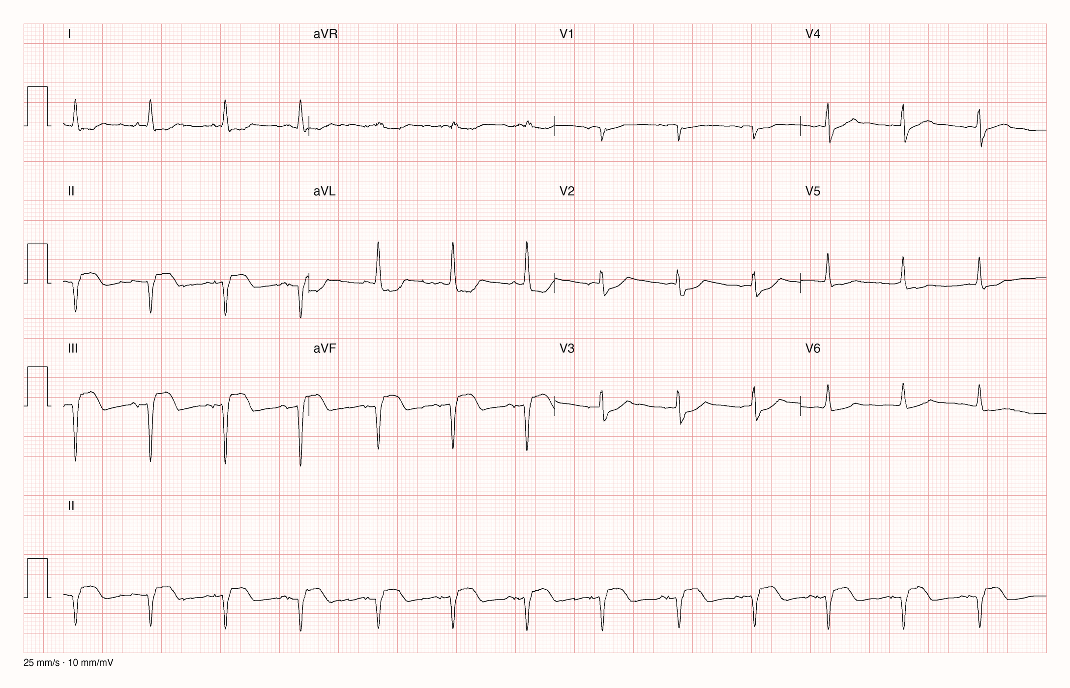 EKG-Aufnahme PTBXL-532; beurteile zunächst selbst die sichtbare Kurve