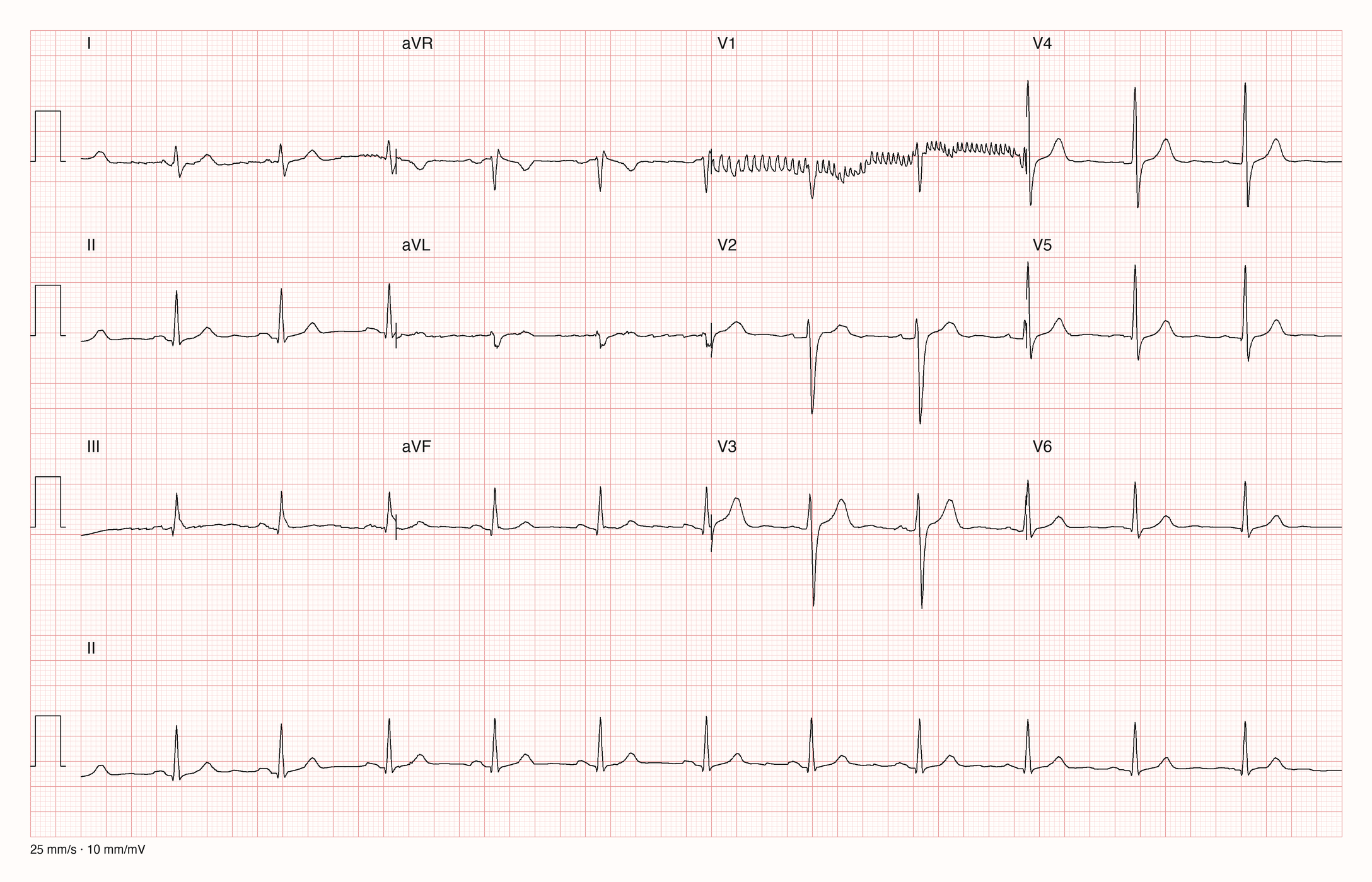 EKG-Aufnahme PTBXL-59; beurteile zunächst selbst die sichtbare Kurve